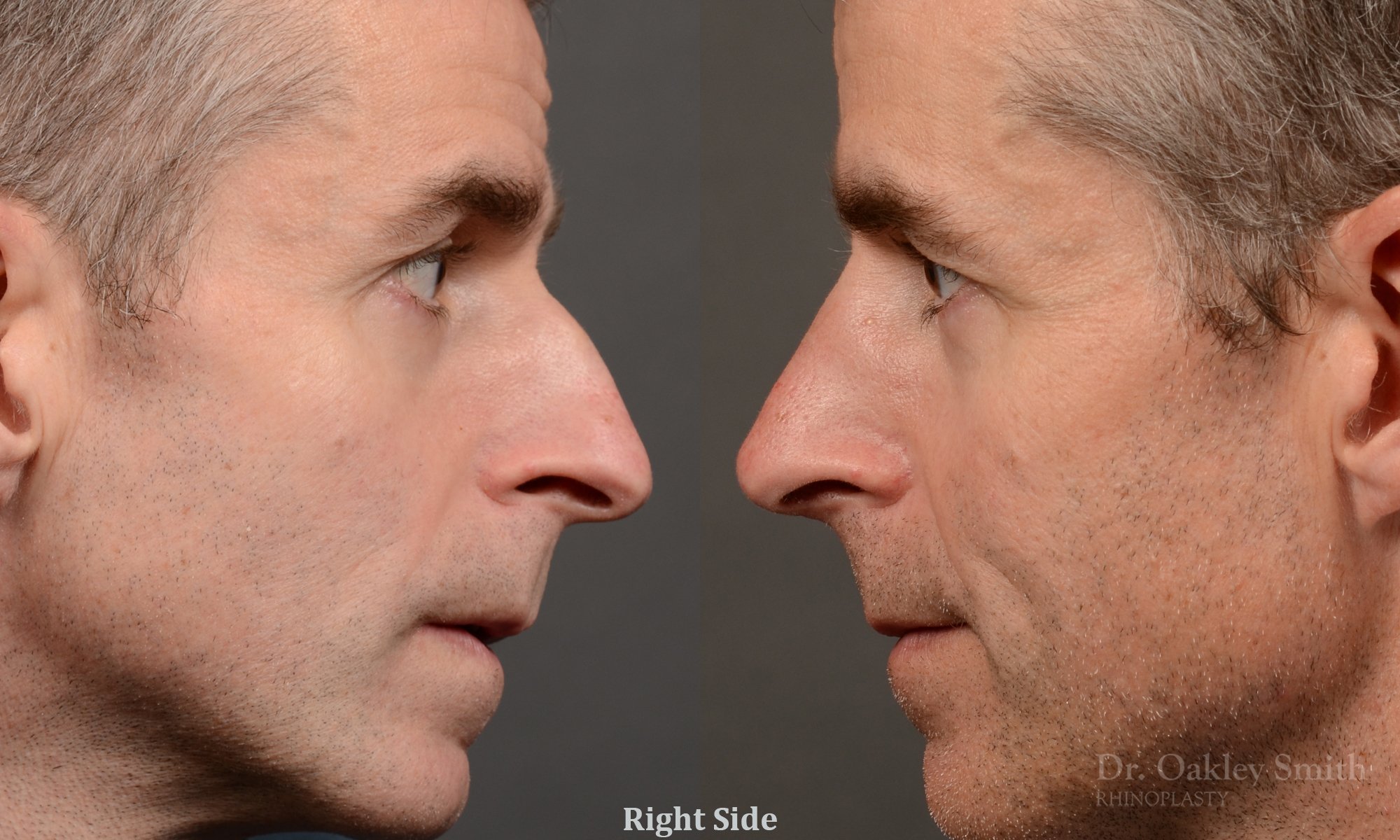 535: Primary Male Rhinoplasty, Normal Skin, Bridge Work, Tip Work