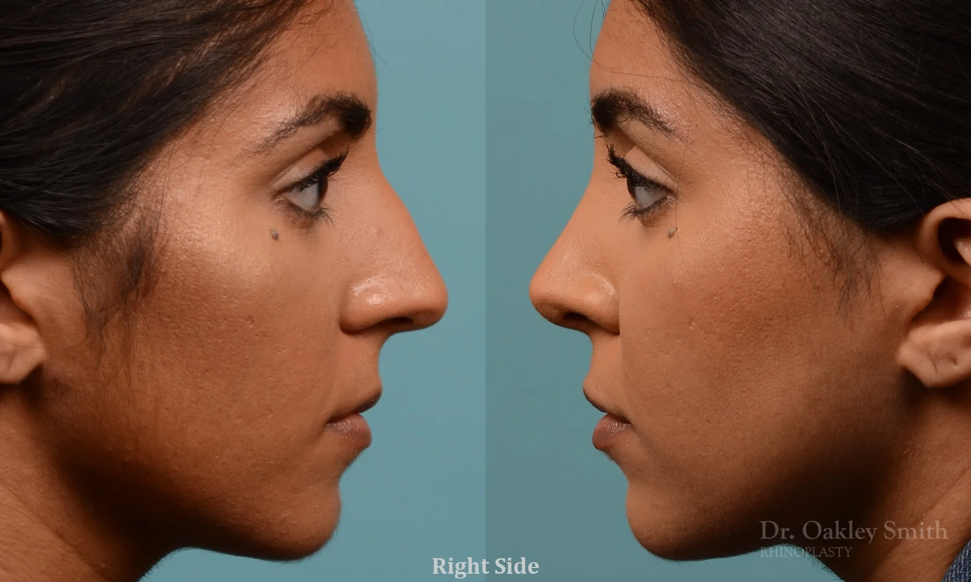 303.1C-rhinoplasty-dr-oakley-smith-toronto-nose-job.jpg