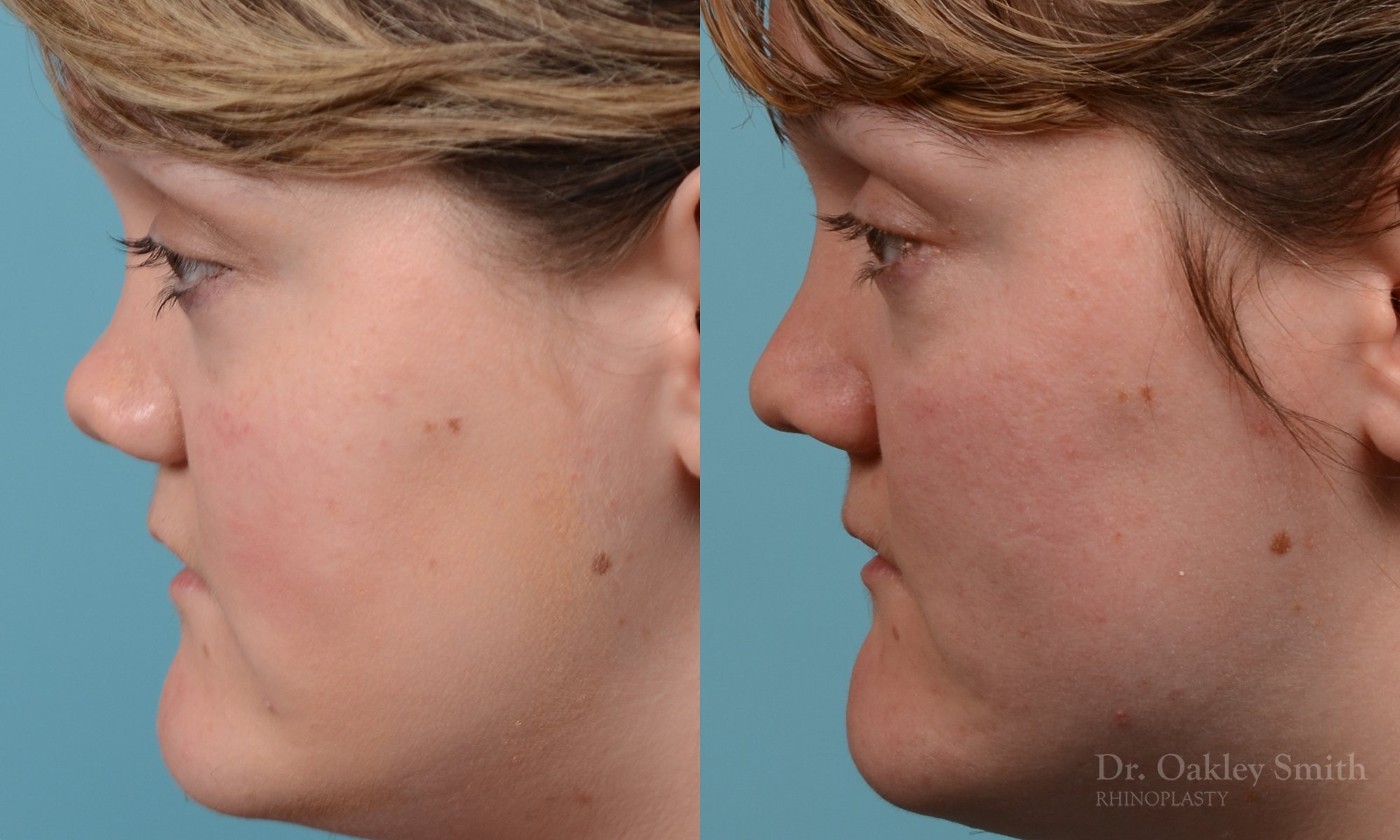 241E-rhinioplasty-nose-job-dr-oakley-smith-toronto-1.jpg