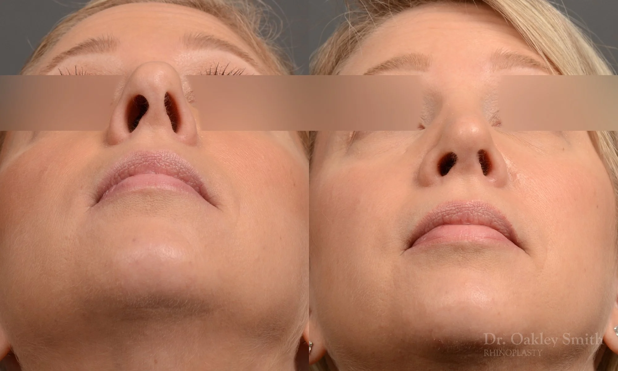 344F-rhinoplasty-dr-oakley-smith-toronto-nose-job-1.jpg