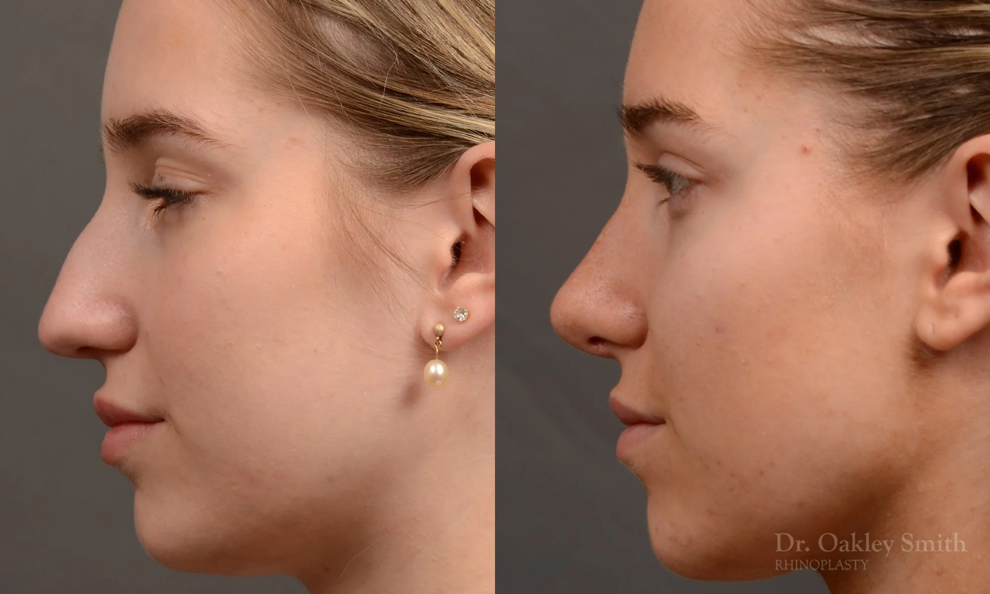 537E-rhinoplasty-before-after-top-toronto-nose-surgeon.jpg