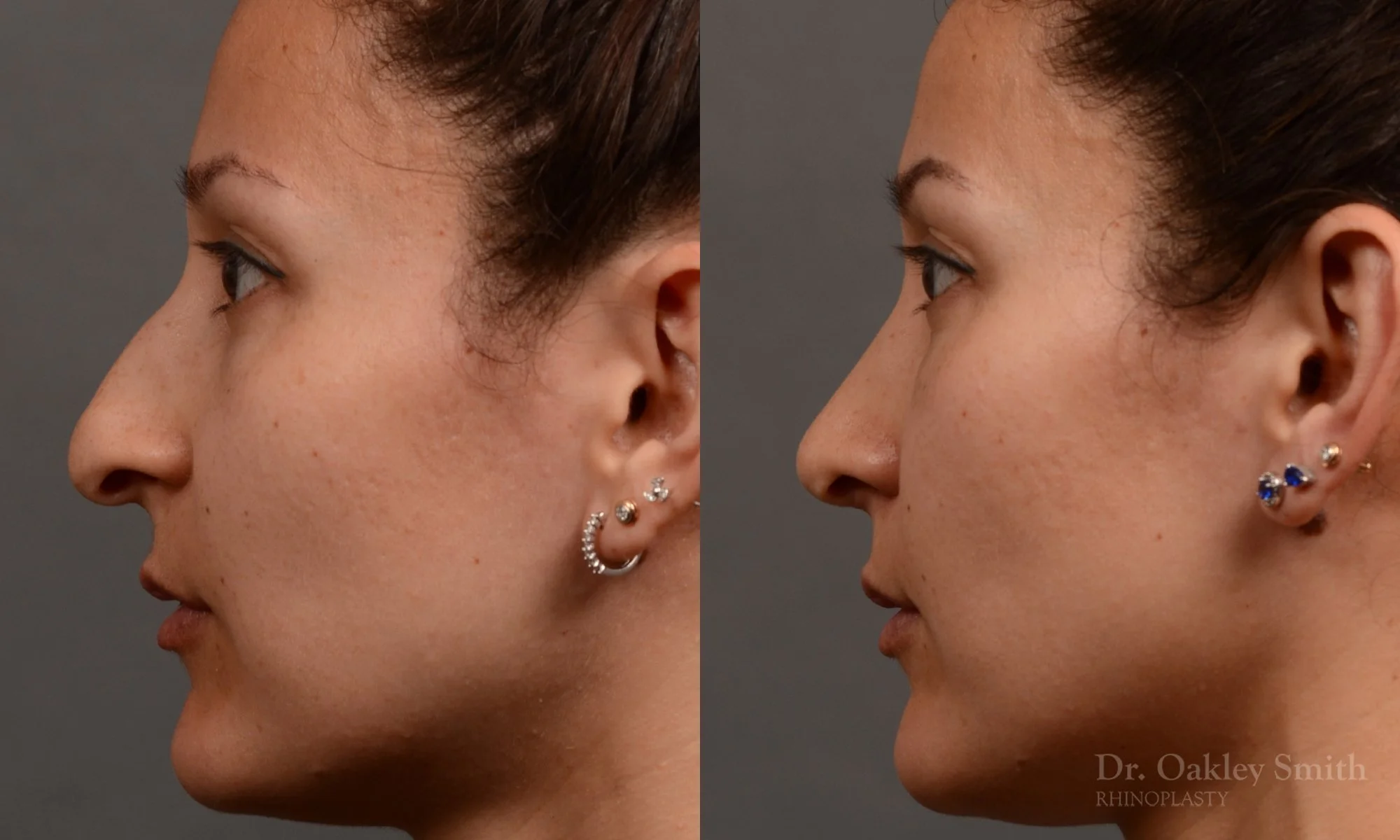 332E-rhinoplasty-dr-oakley-smith-toronto-nose-job.jpg