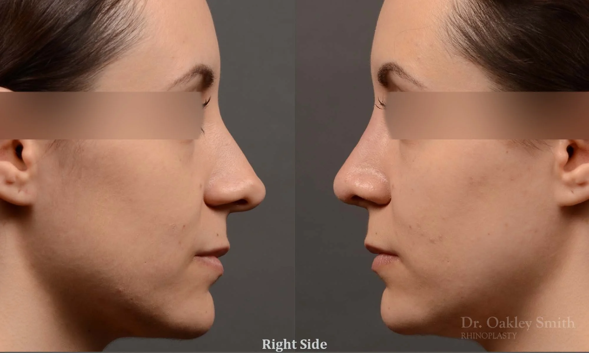 341C-rhinoplasty-dr-oakley-smith-toronto-nose-job.jpg