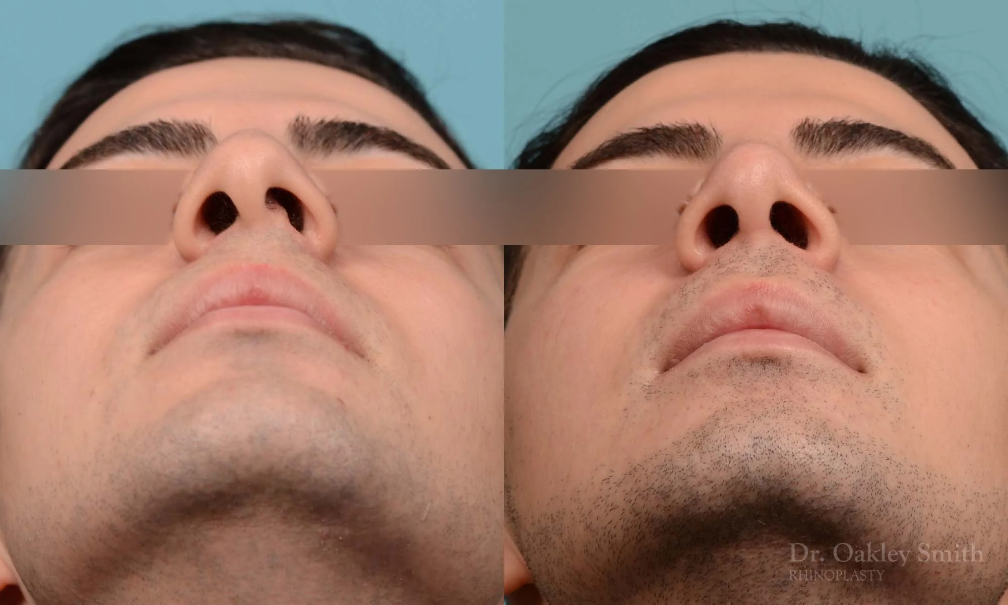 253F-rhinoplasty-dr-oakley-smith-toronto-male-nose-job.jpg