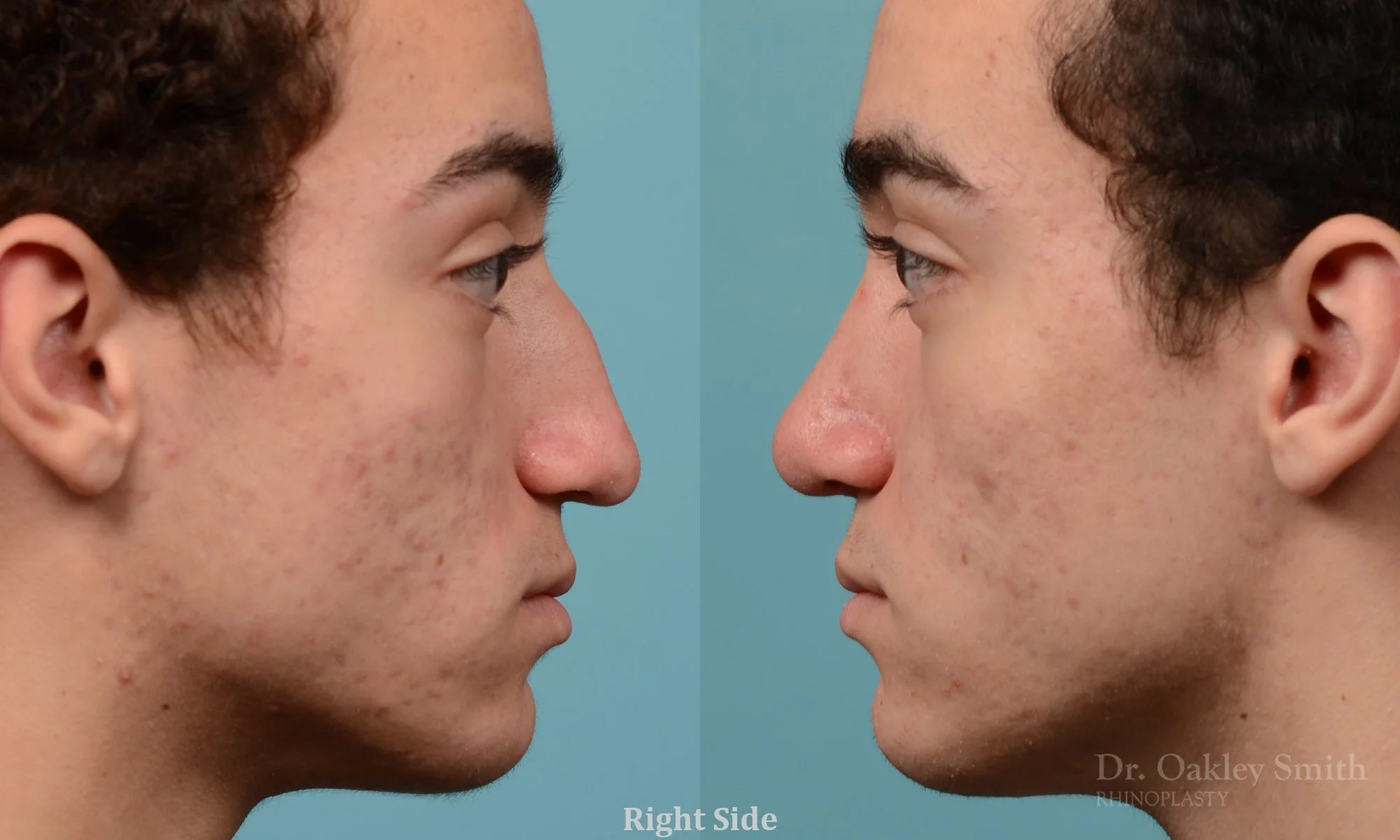 212: Primary Male Rhinoplasty, Normal Skin,  Dorsal Straightening, Tip Refinement