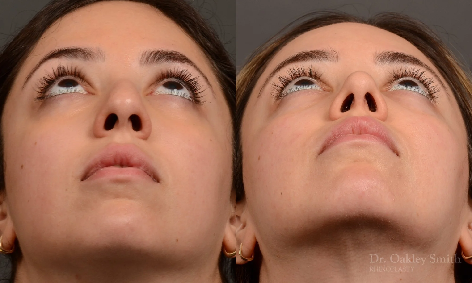 507F-rhinoplasty-dr-oakley-smith-toronto-top-surgeon-nose-job.jpg