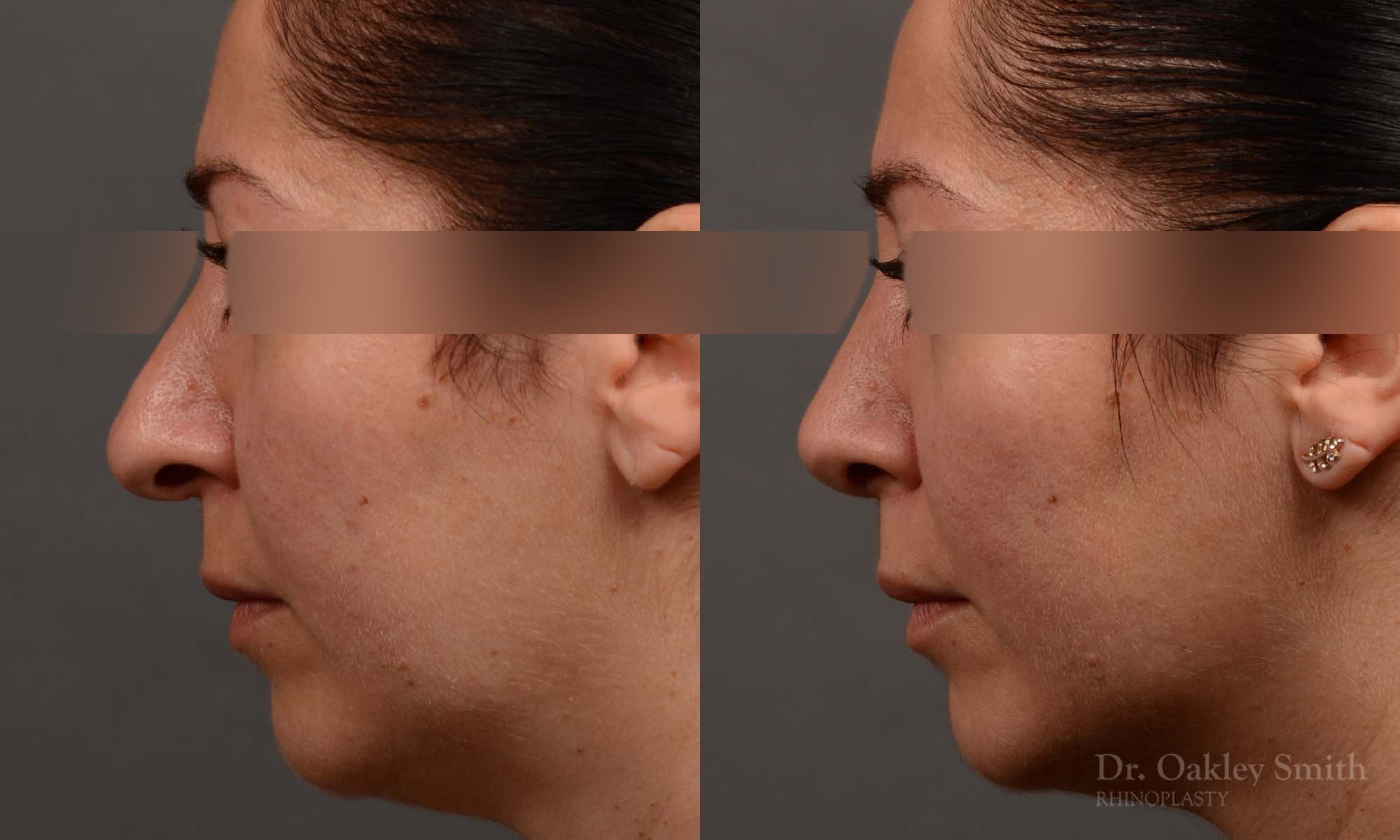 331E-rhinoplasty-dr-oakley-smith-toronto-nose-job.jpg