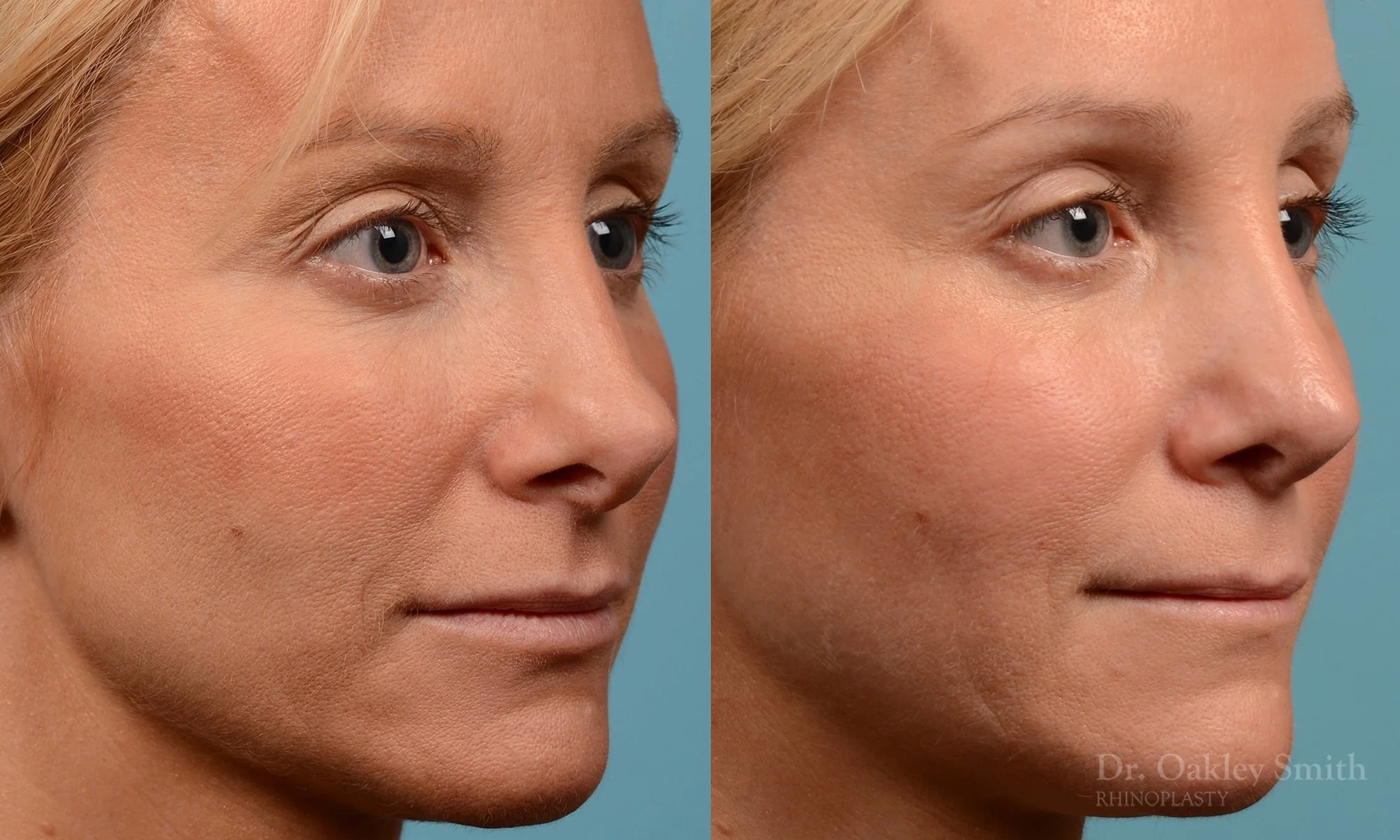232B-rhinoplasty-dr-oakley-smith-nose-job-large-nose-long-nose-1.jpg