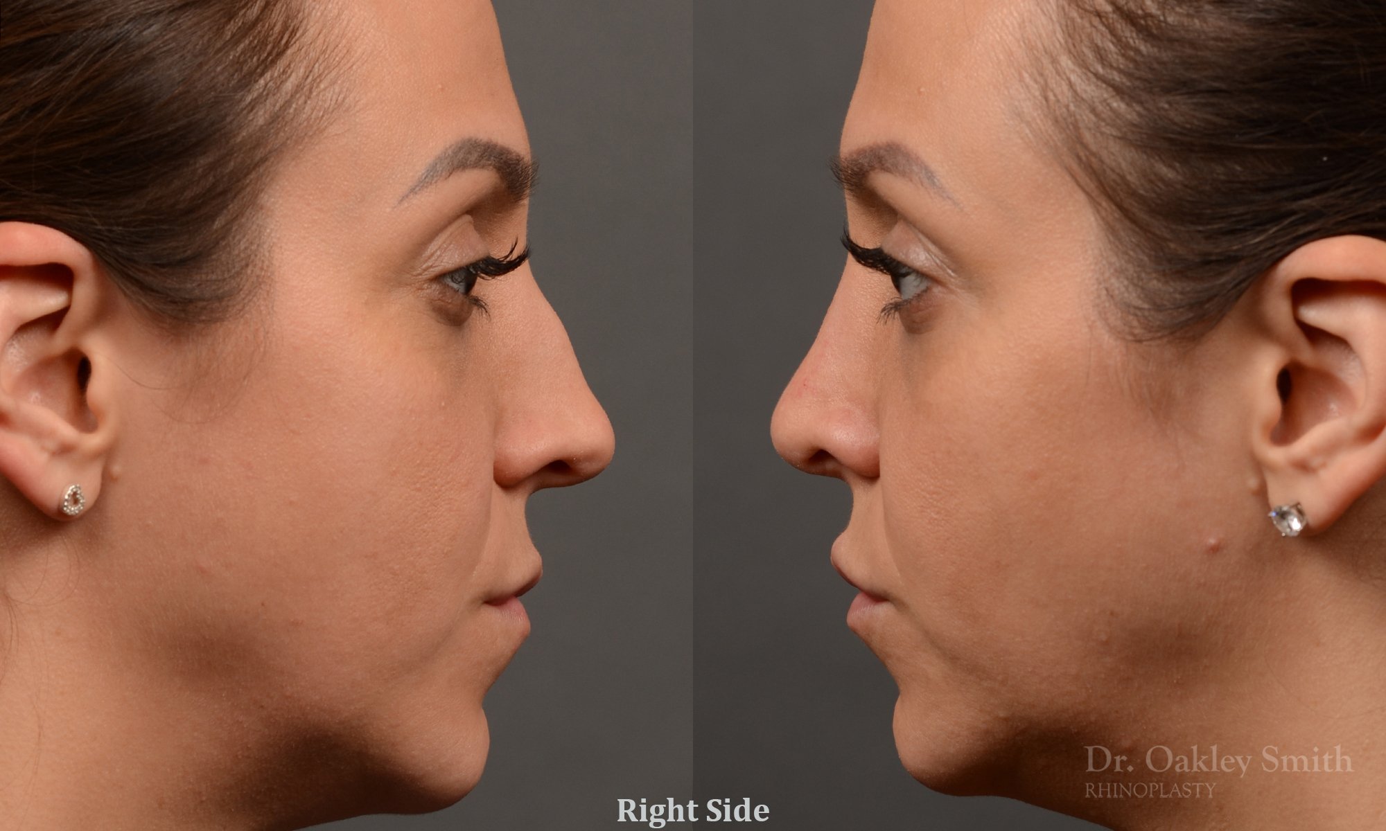 353: Female, Ethnic Rhinoplasty, Thick Skin, Dorsal Hump, Tip Refinement