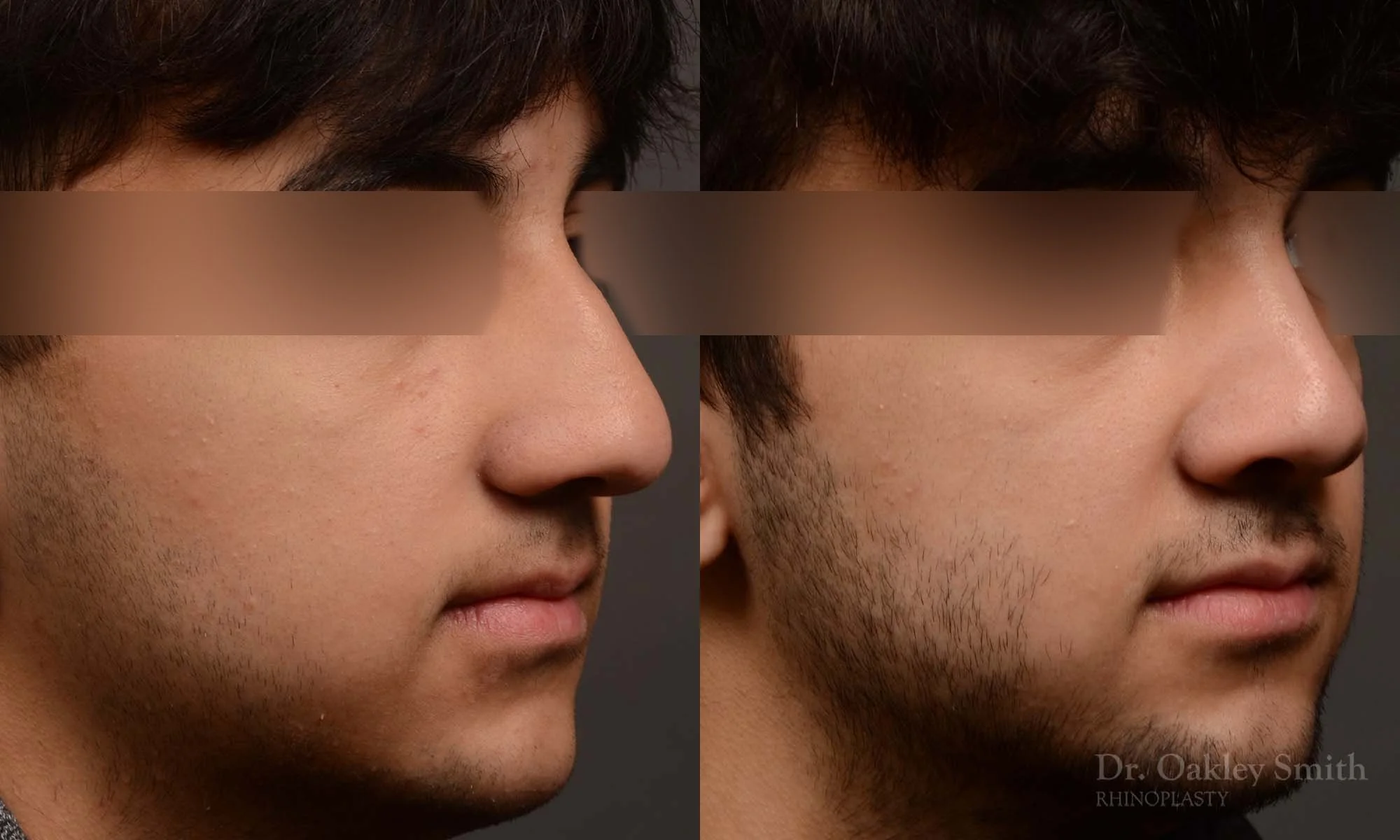 520B-male-rhinoplasty-dr-oakley-smith-toronto-top-surgeon-nose-job.jpg