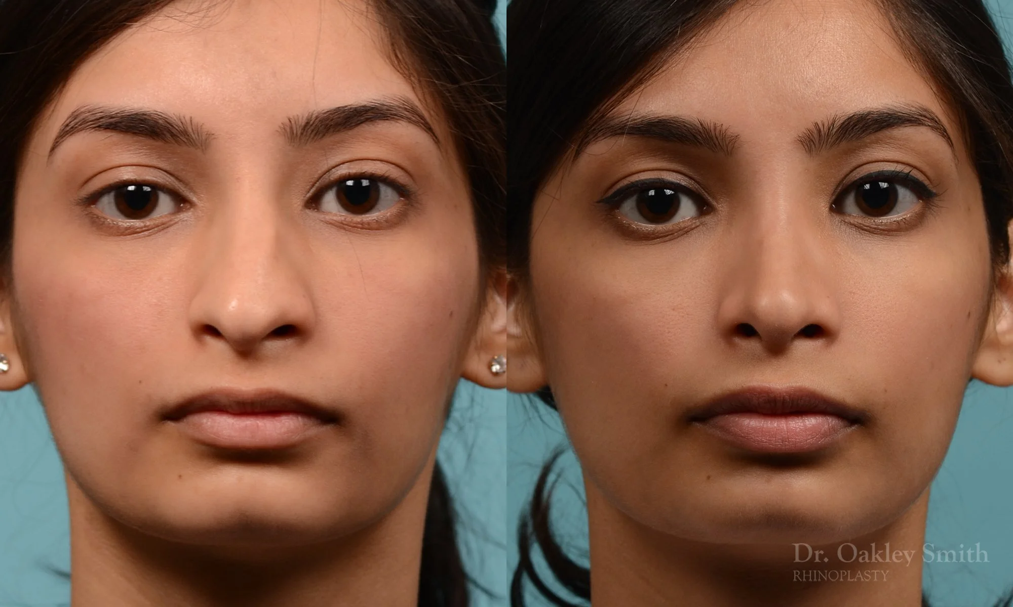 272.5A-rhinoplasty-dr-oakley-smith-toronto-nose-job.jpg