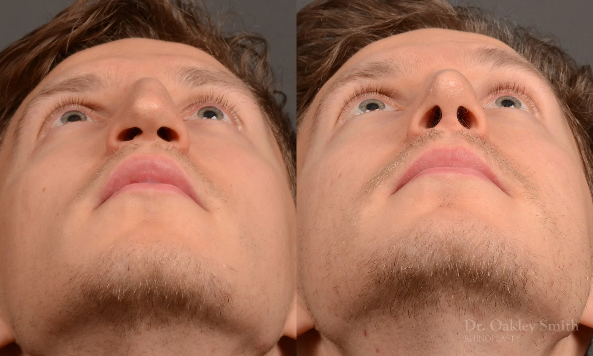 498F-rhinoplasty-dr-oakley-smith-toronto-top-surgeon-nose-job.jpg