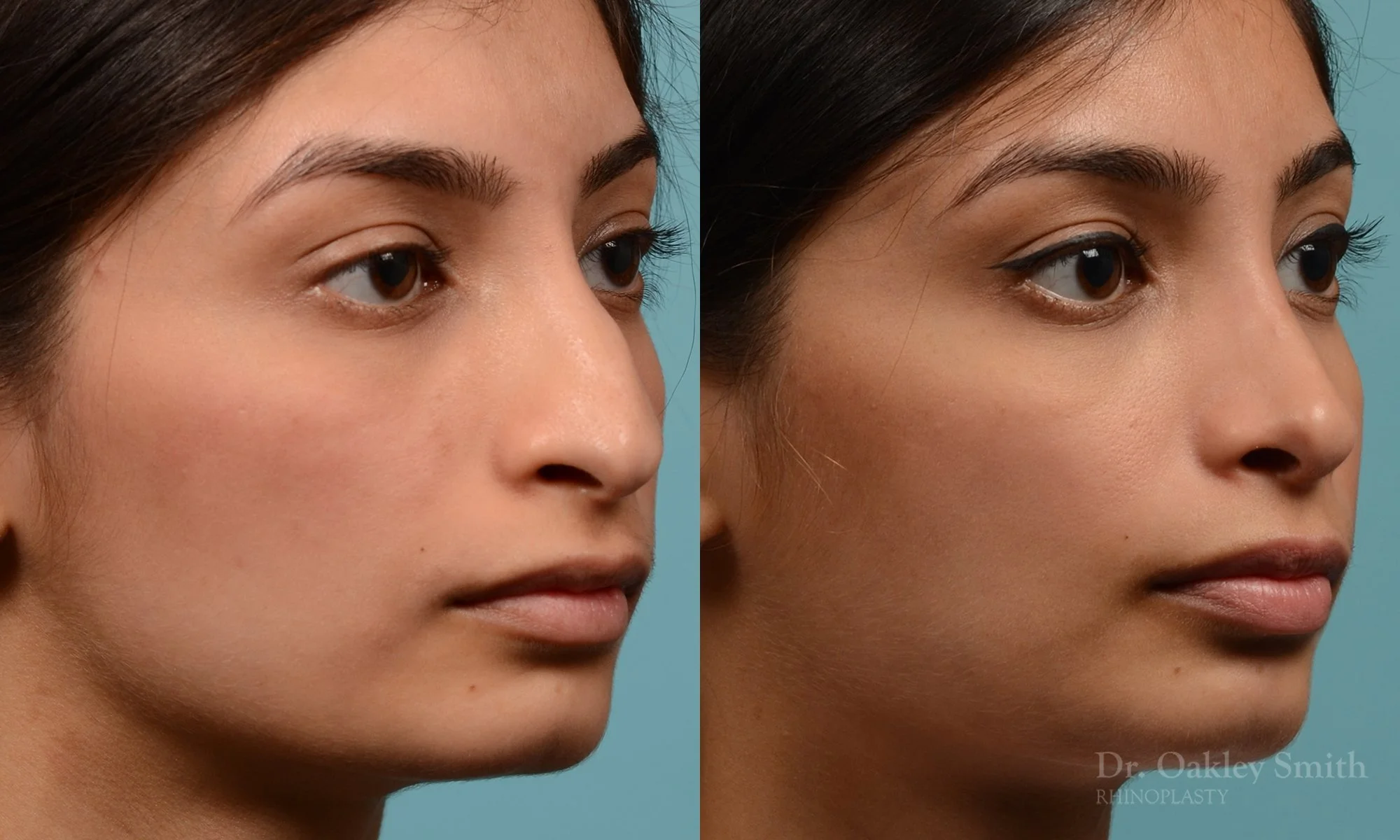 272.5B-rhinoplasty-dr-oakley-smith-toronto-nose-job.jpg