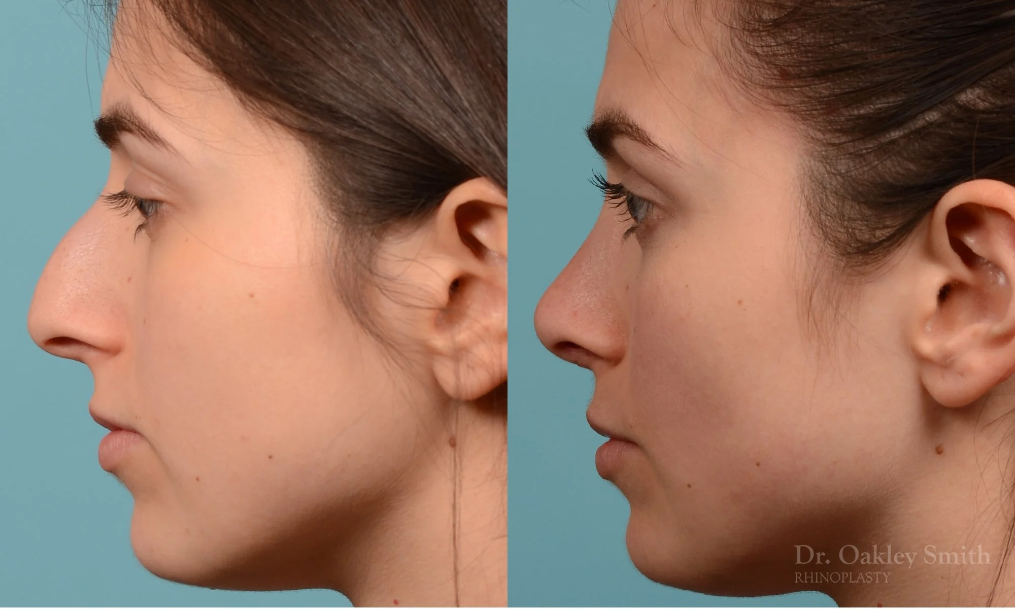 289E-rhinoplasty-dr-oakley-smith-toronto-nose-job.jpg