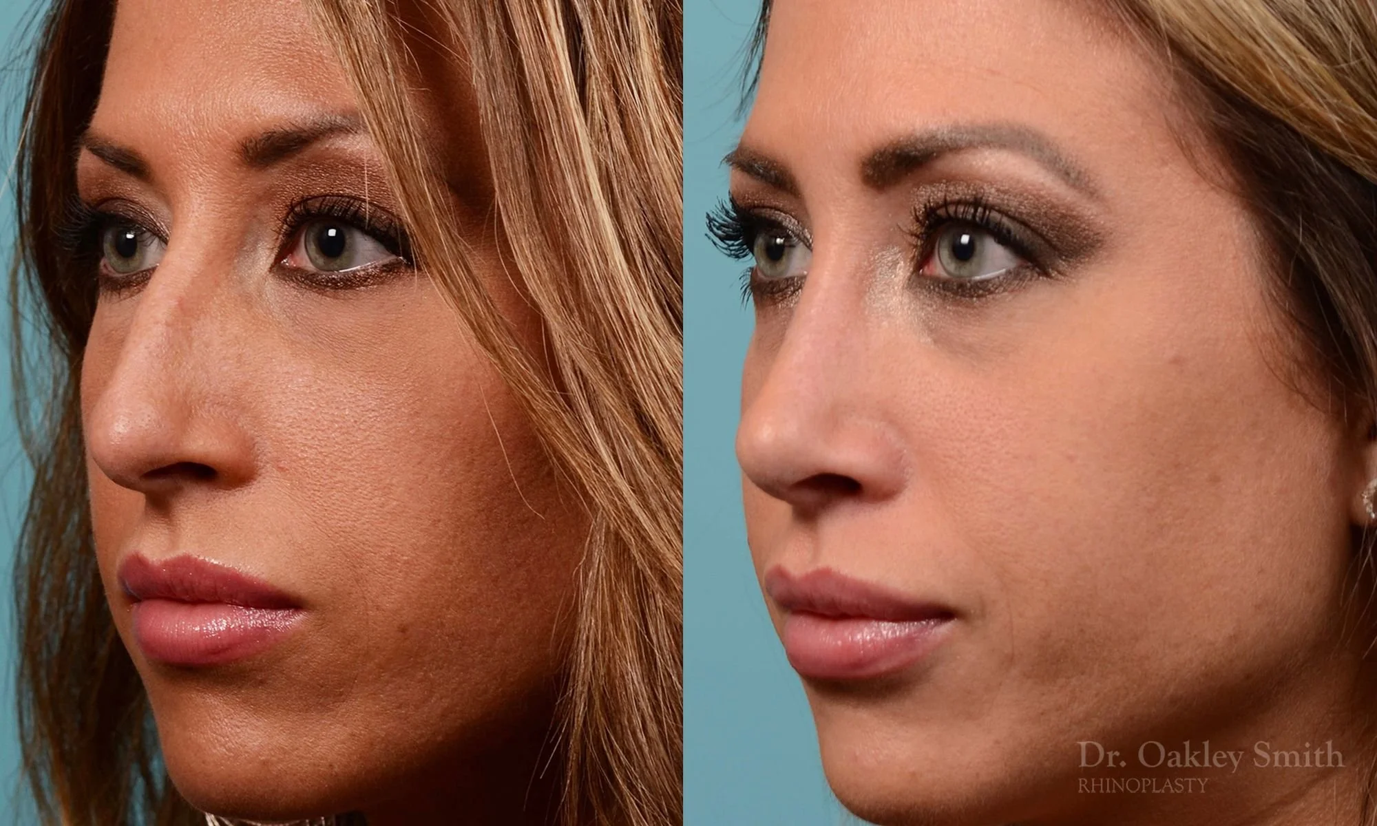 208D-watermark-rhinoplasty-toronto-dr-oakley-smith-female-nose-job-nose-job-big-nose-bump-bridge-1 (1).jpg