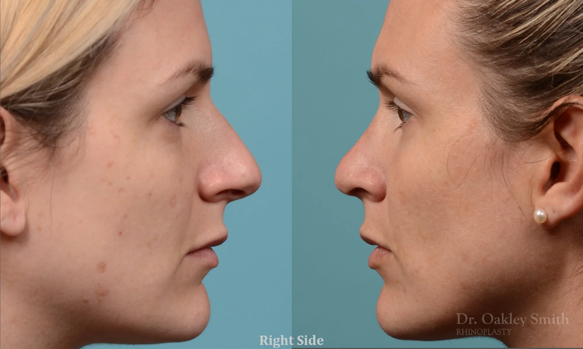 311: Female Rhinoplasty, Dorsal Hump, Tip Narrowing Refinement