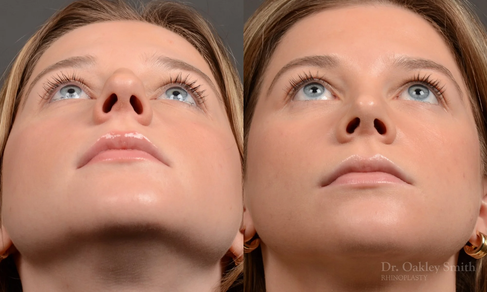 536F-rhinoplasty-dr.-oakley-smith-toronto-nose-job-best.jpg