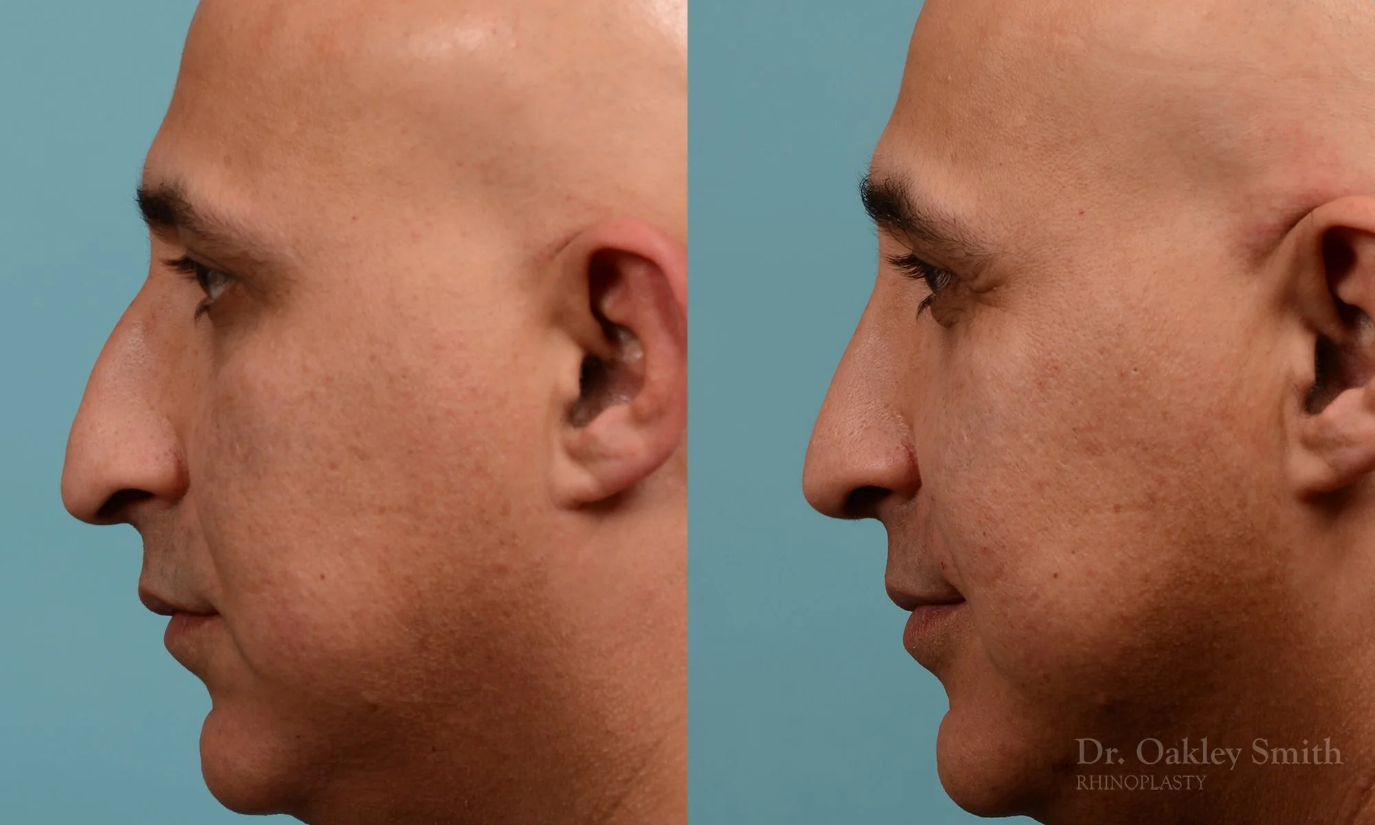 349.1E-rhinoplasty-dr-oakley-smith-toronto-nose-job.jpg