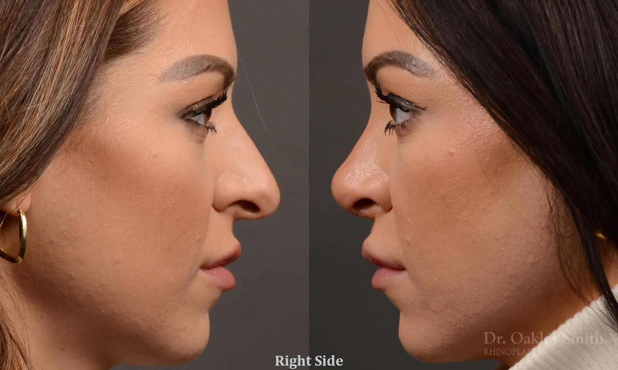 524: Female, Ethnic Rhinoplasty, Thick Skin, Tip Narrowed and Raised