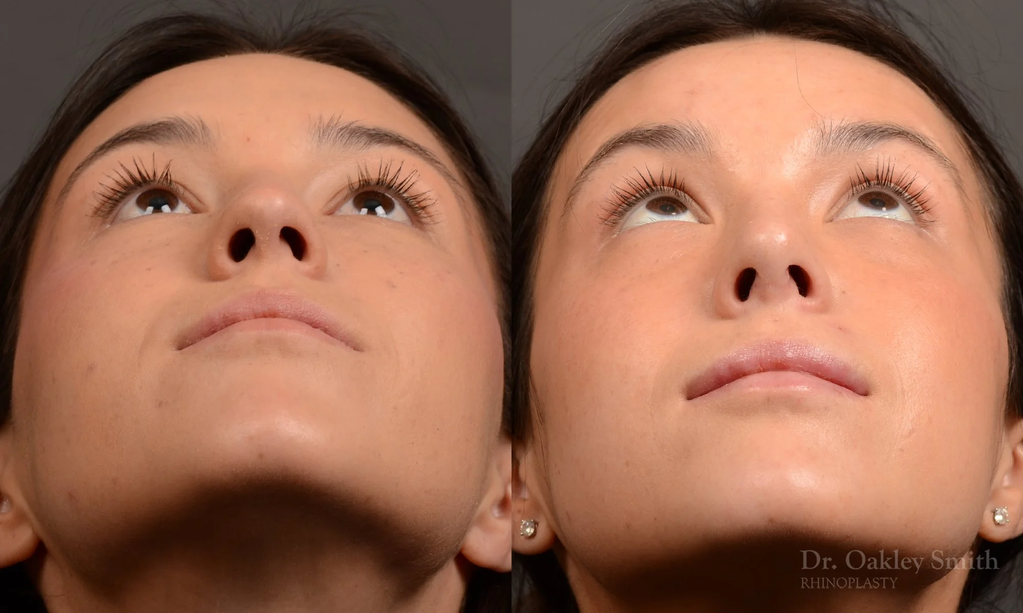 549F-rhinoplasty-nose-job-toronto-nose-surgeon-dr-oakley-smith.jpg