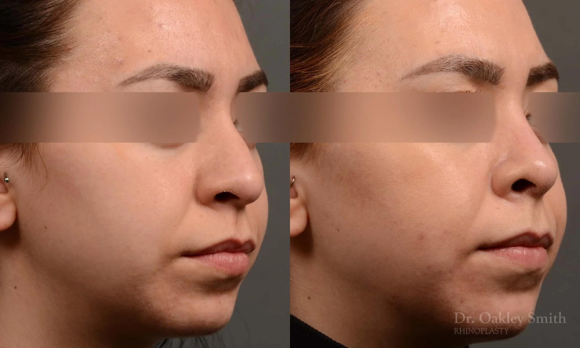 342B-rhinoplasty-dr-oakley-smith-toronto-nose-job.jpg