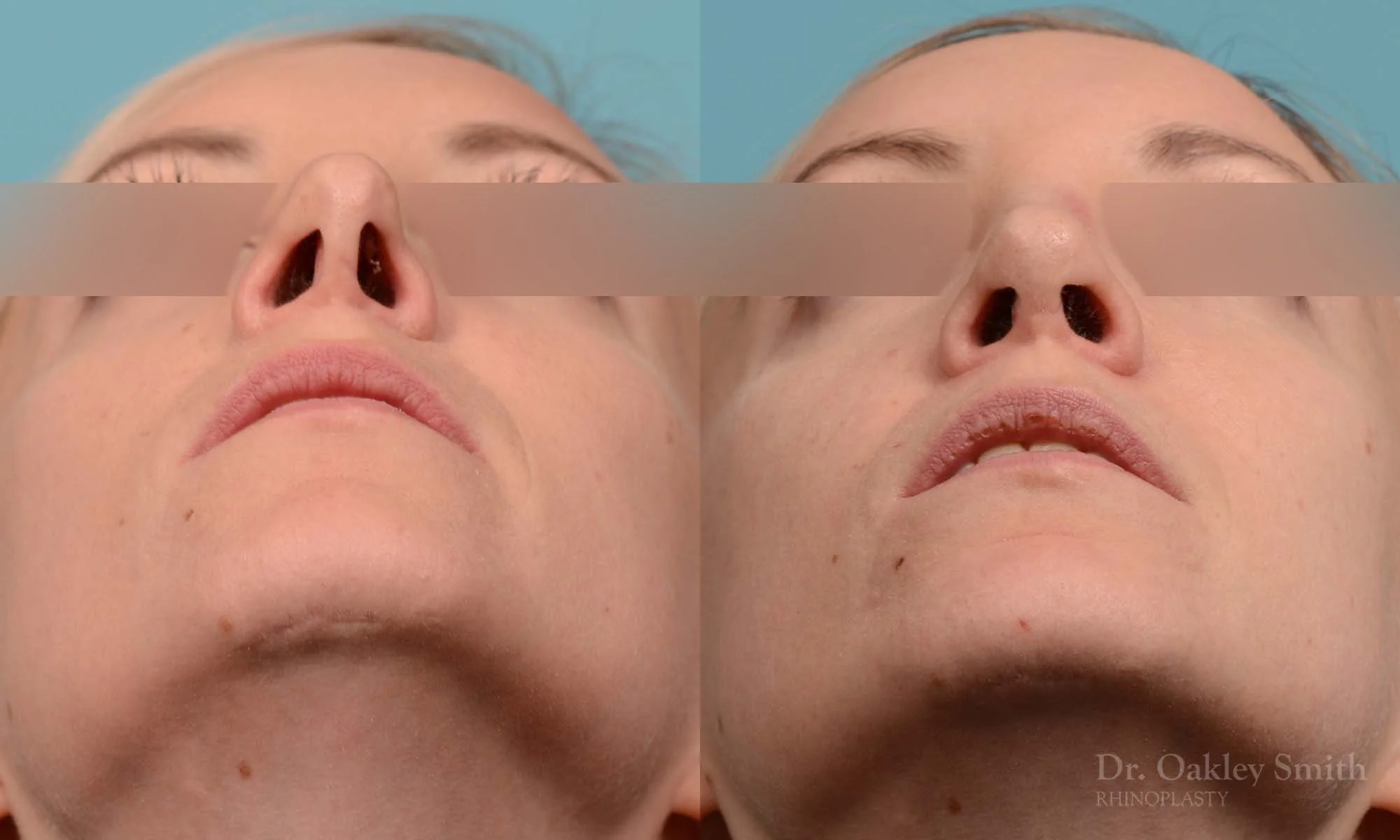 280F-rhinoplasty-dr-oakley-smith-toronto-nose-job.jpg
