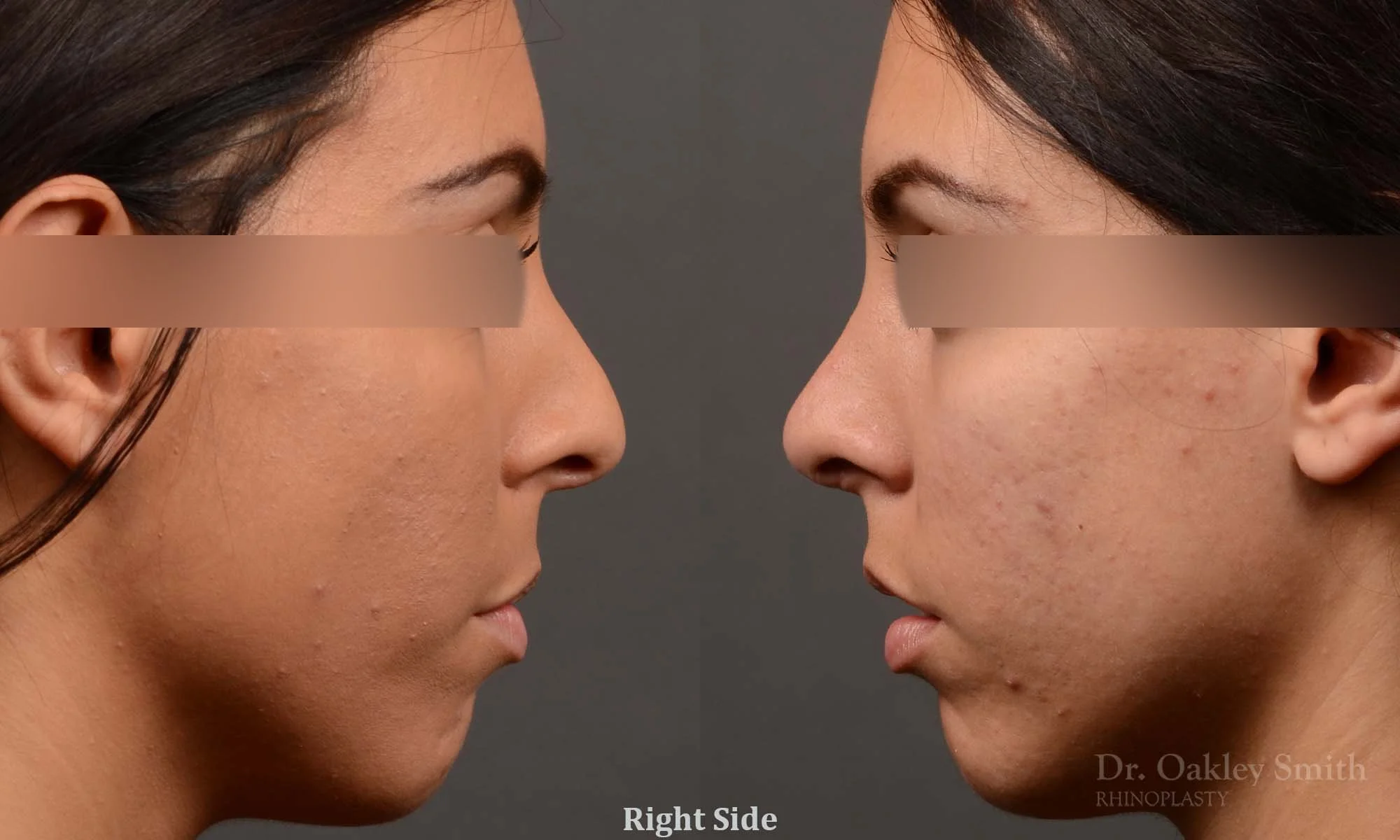 320: Female, Ethnic Rhinoplasty, Dorsal Hump, Wide Bridge,  Tip Refinement
