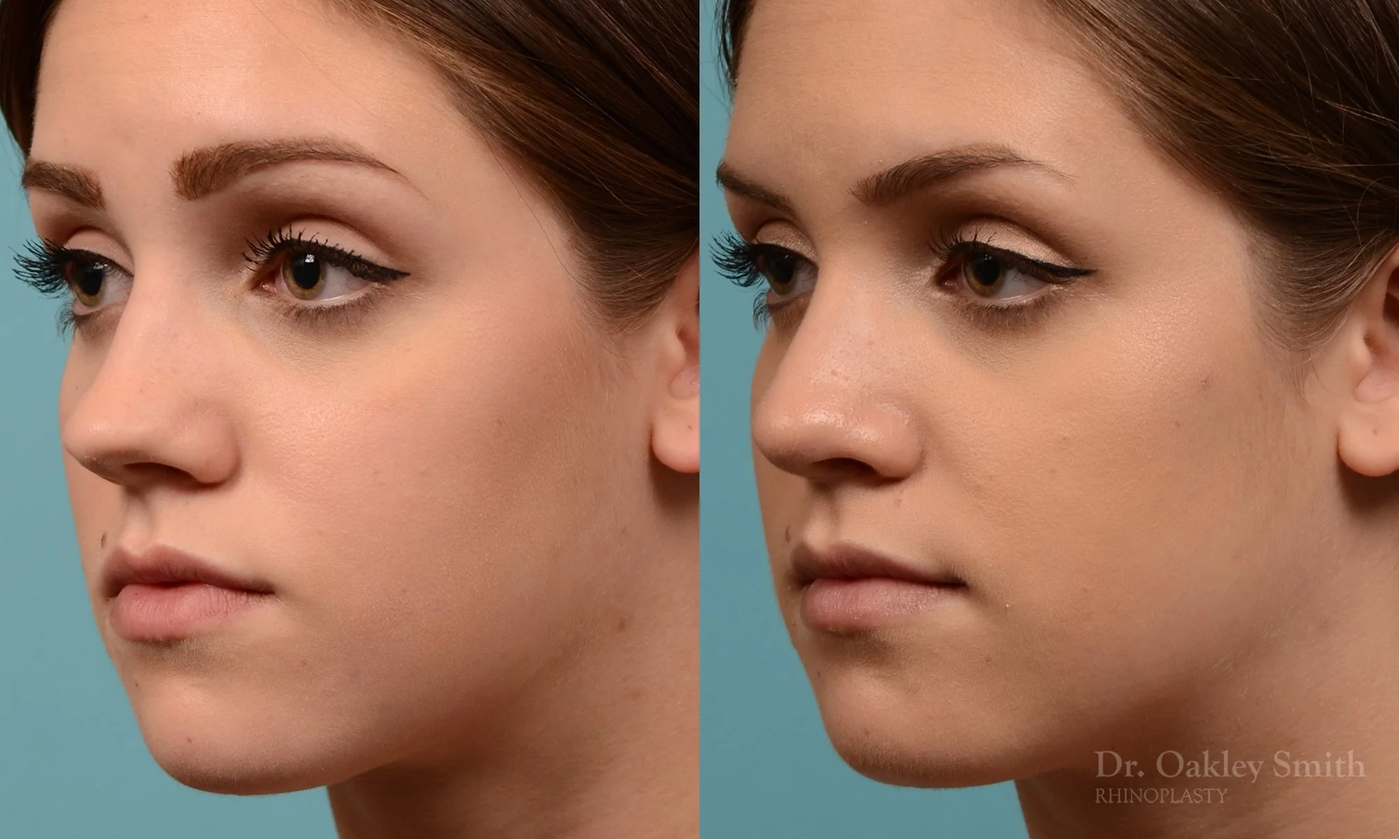 293D-rhinoplasty-dr-oakley-smith-toronto-nose-job.jpg