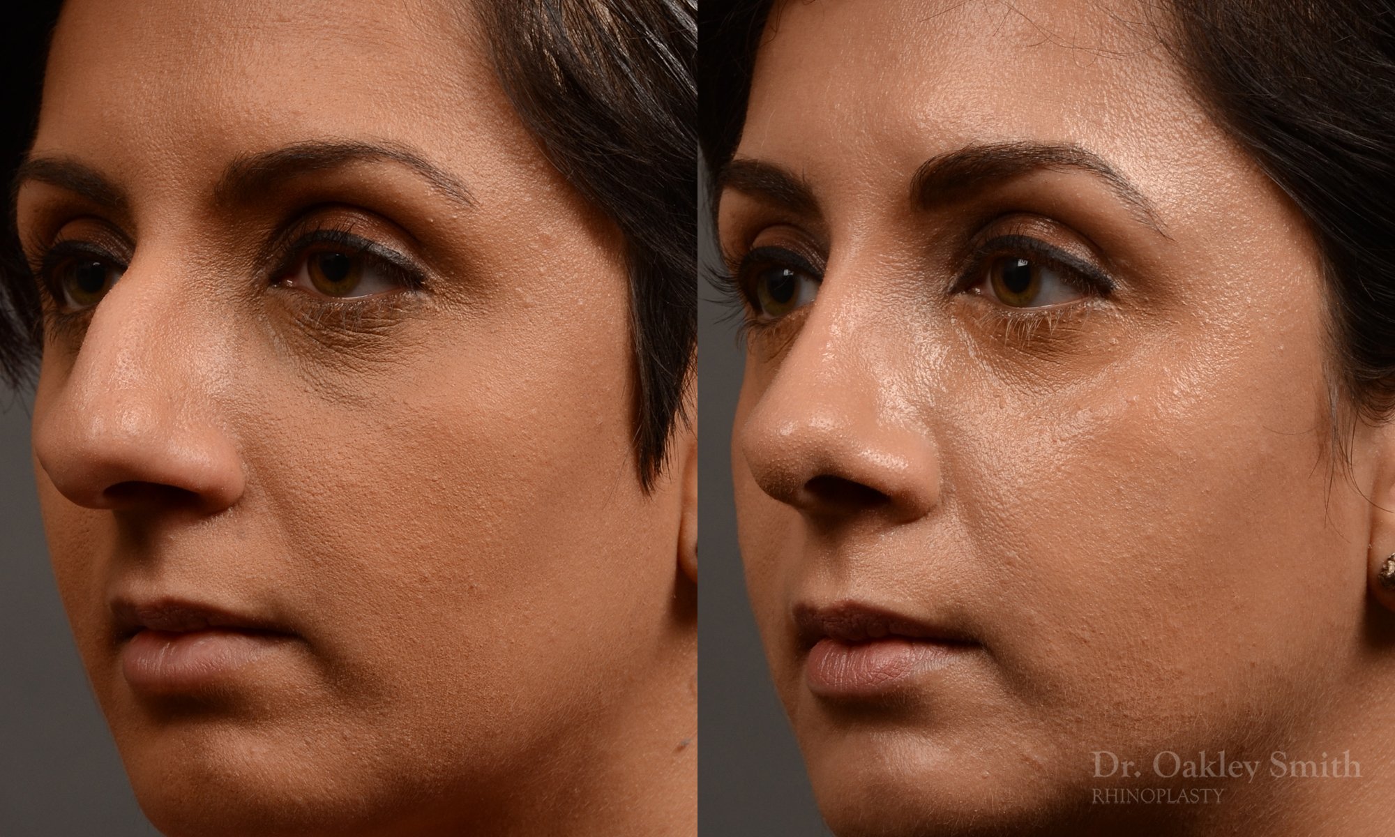 376.1D-rhinoplasty-dr-oakley-smith-toronto-nose-job.jpg