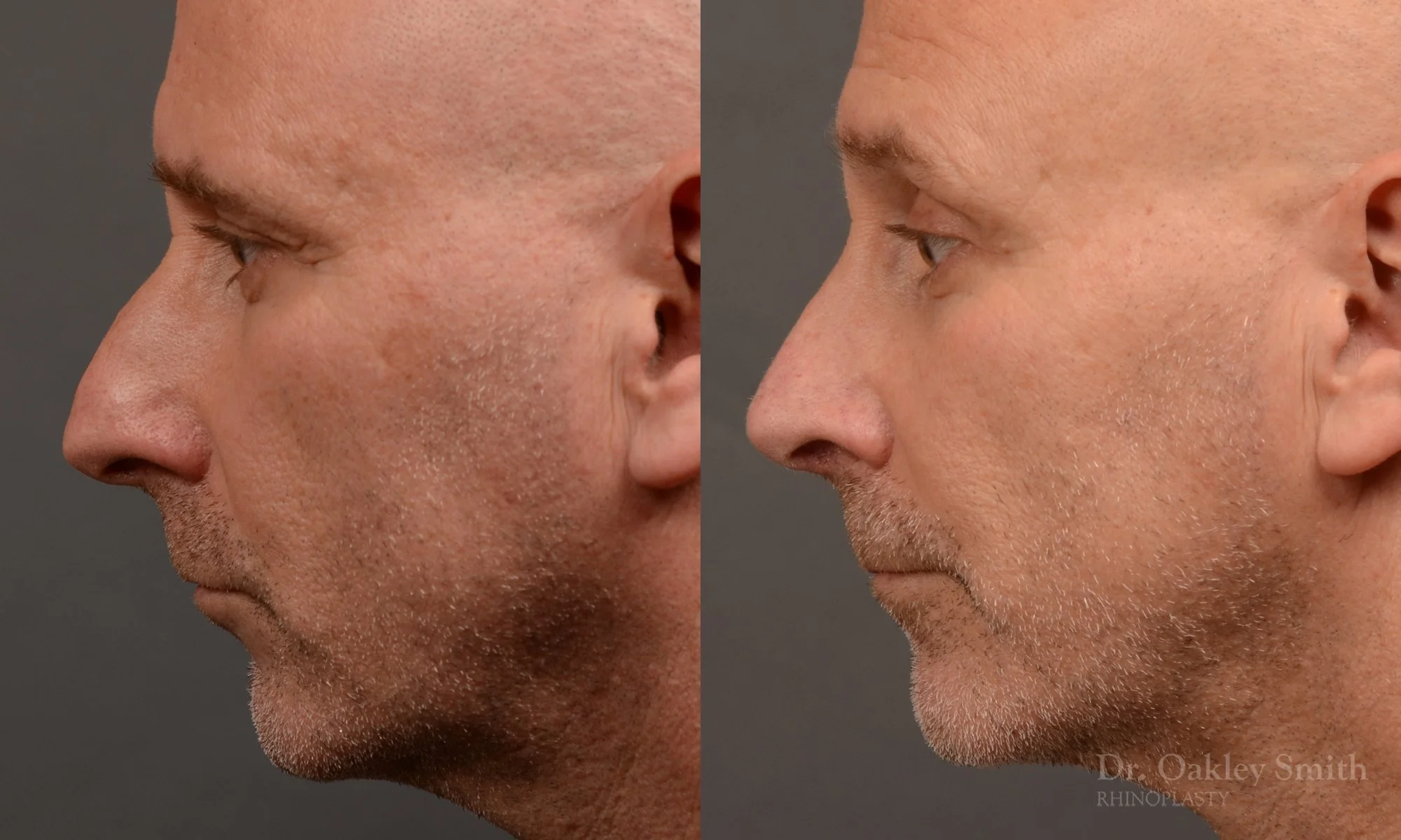 493E-male-rhinoplasty-dr-oakley-smith-toronto-top-surgeon-nose-job.jpg
