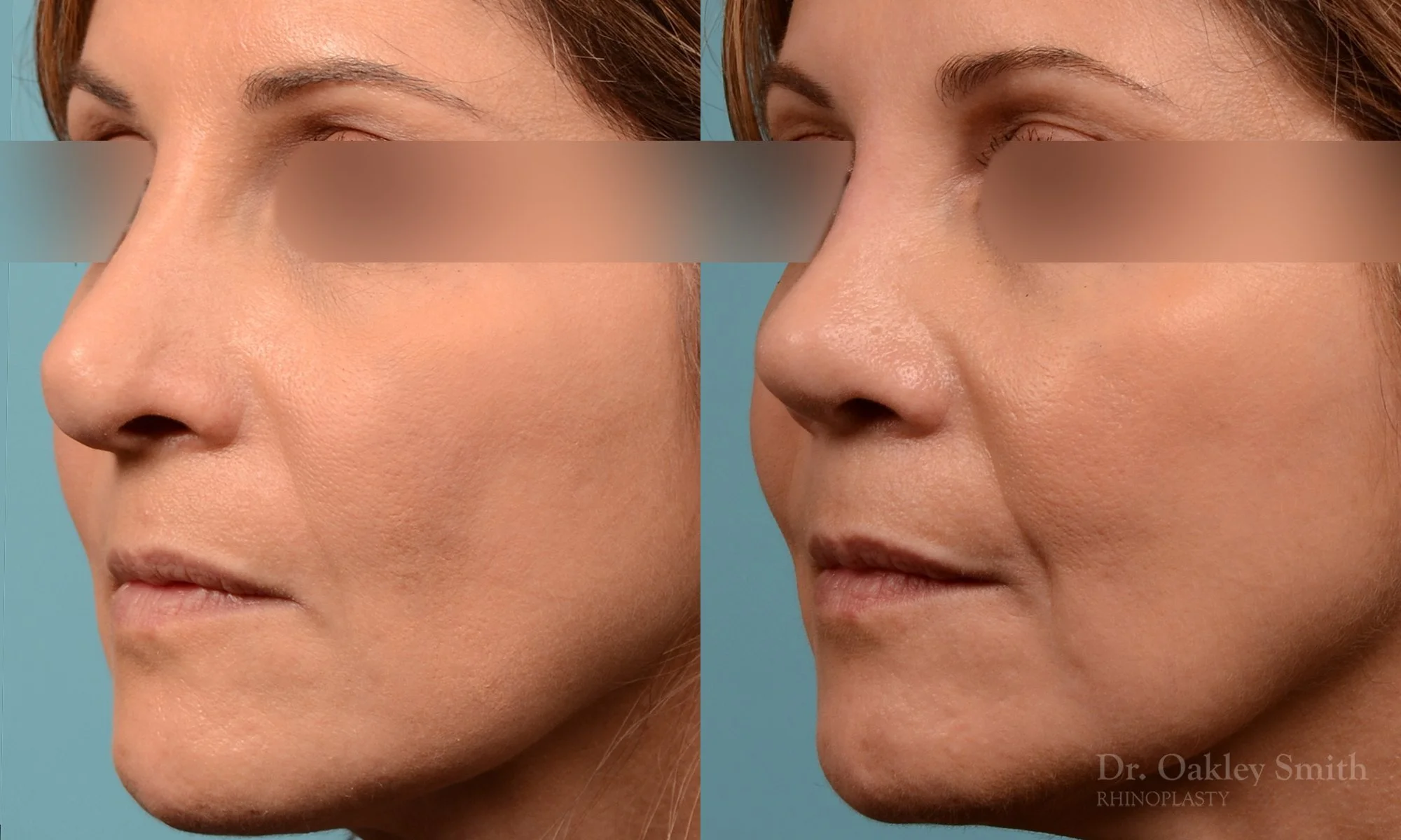 244D-rhinoplasty-dr-oakley-smith-septum.jpg