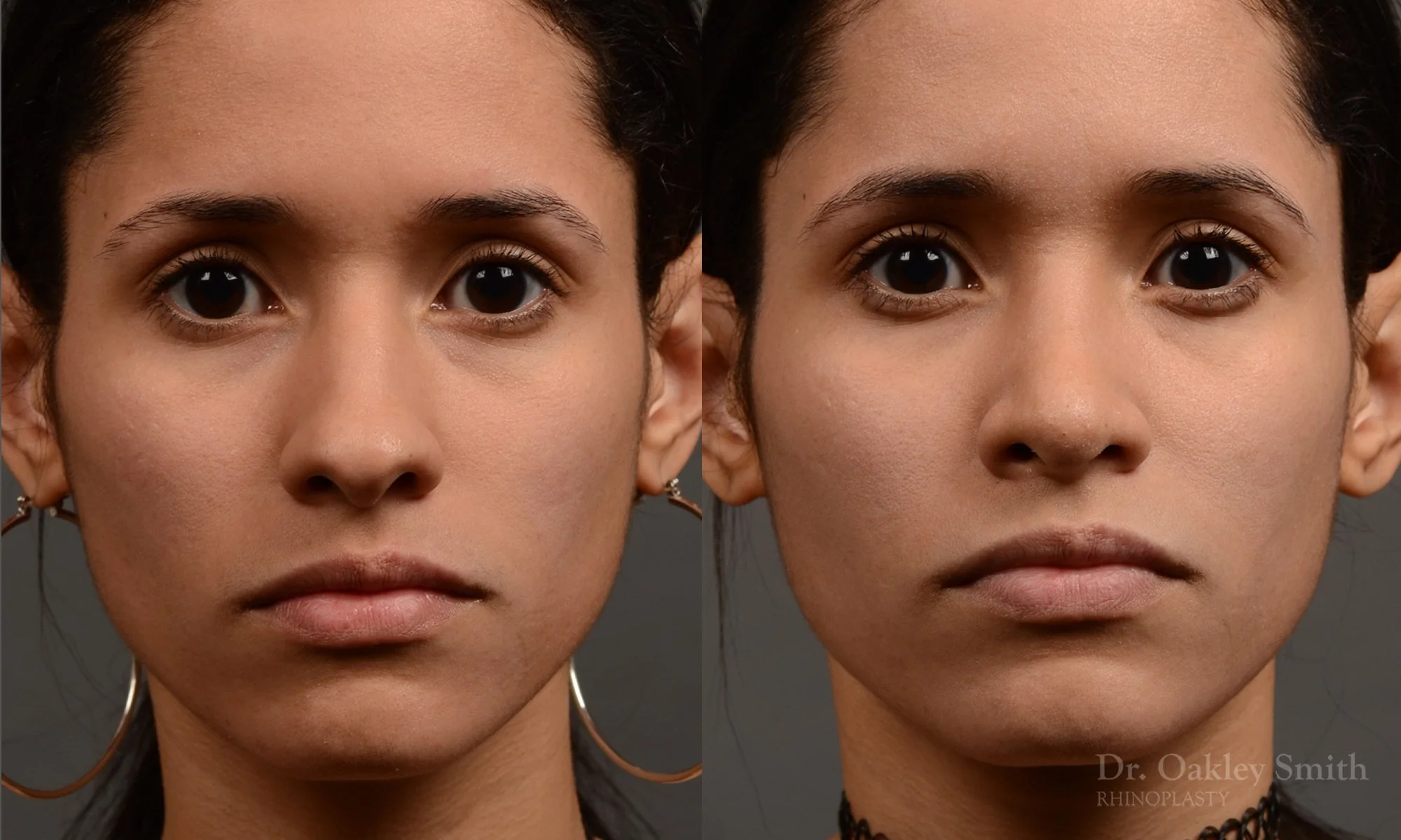 330A-rhinoplasty-dr-oakley-smith-toronto-nose-job.jpg