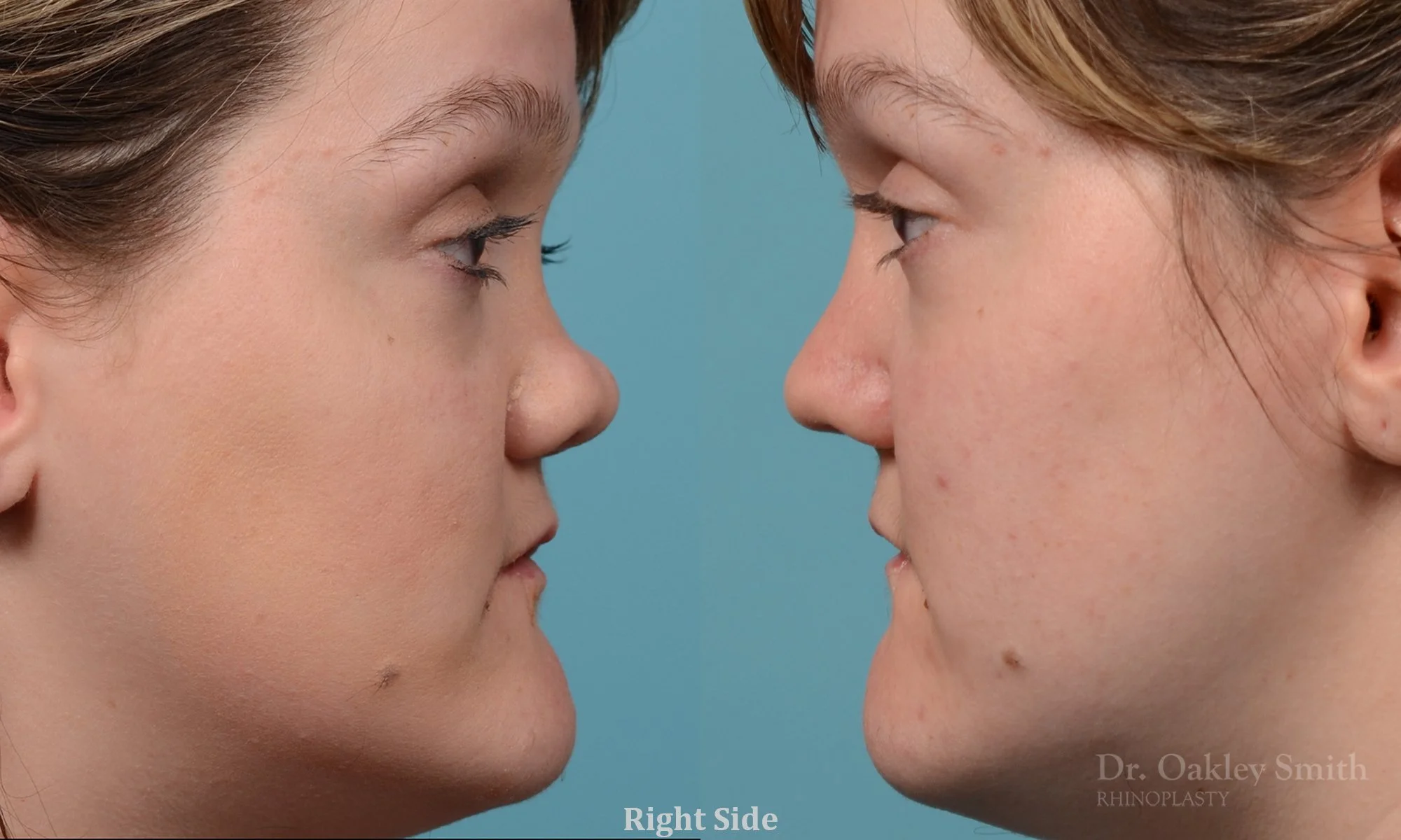241C-rhinioplasty-nose-job-dr-oakley-smith-toronto-1.jpg