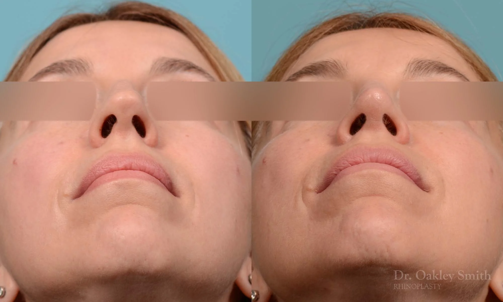 291F-rhinoplasty-dr-oakley-smith-toronto-nose-job.jpg