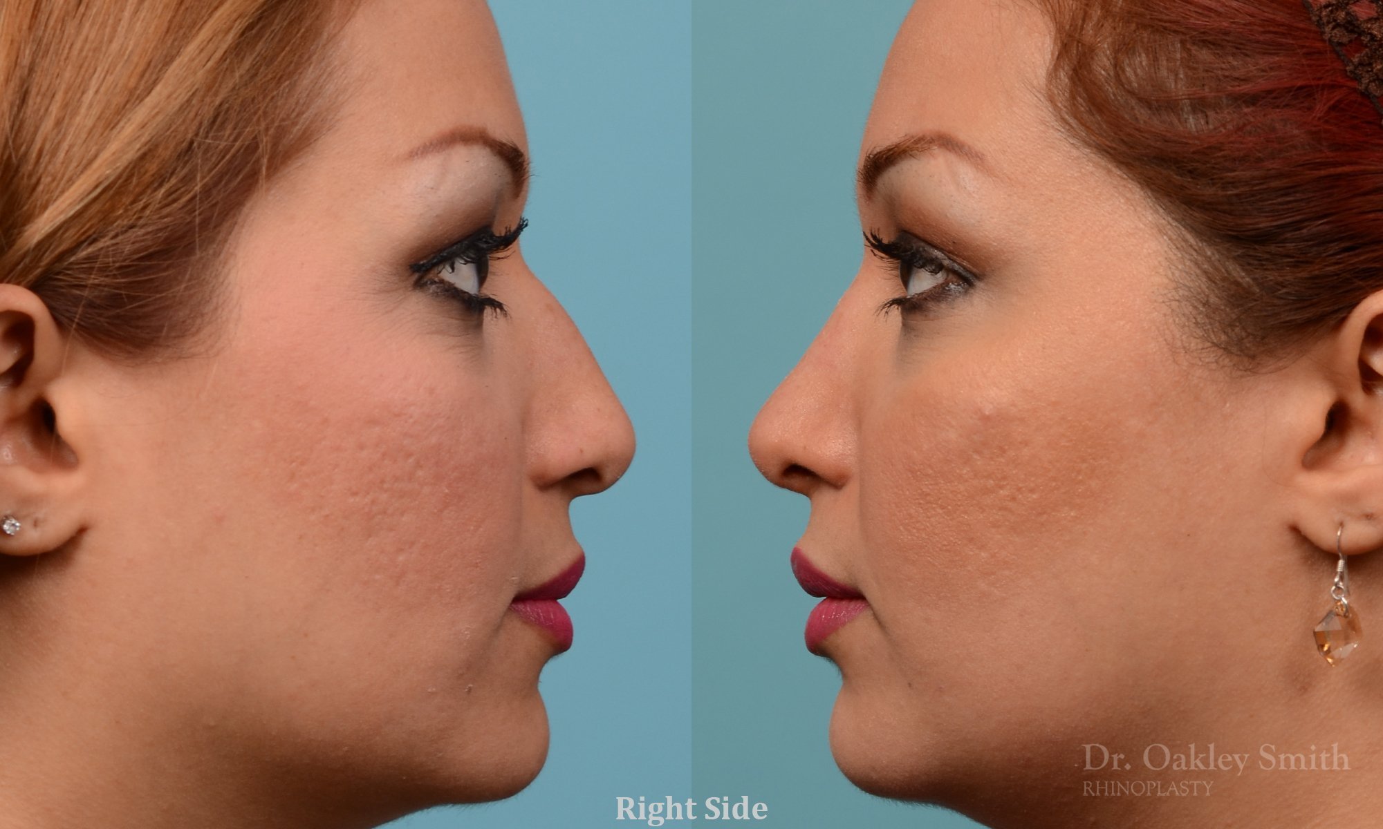 260: Female, Ethnic Rhinoplasty, Thick Skin, Dorsal Hump, Tip Raised