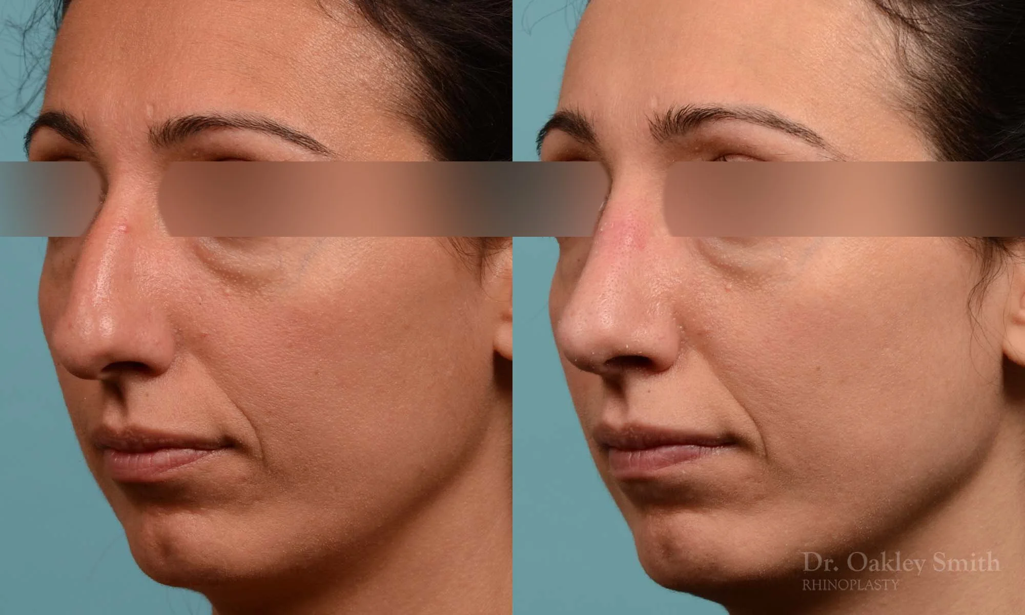 273D-rhinoplasty-dr-oakley-smith-toronto-nose-job.jpg