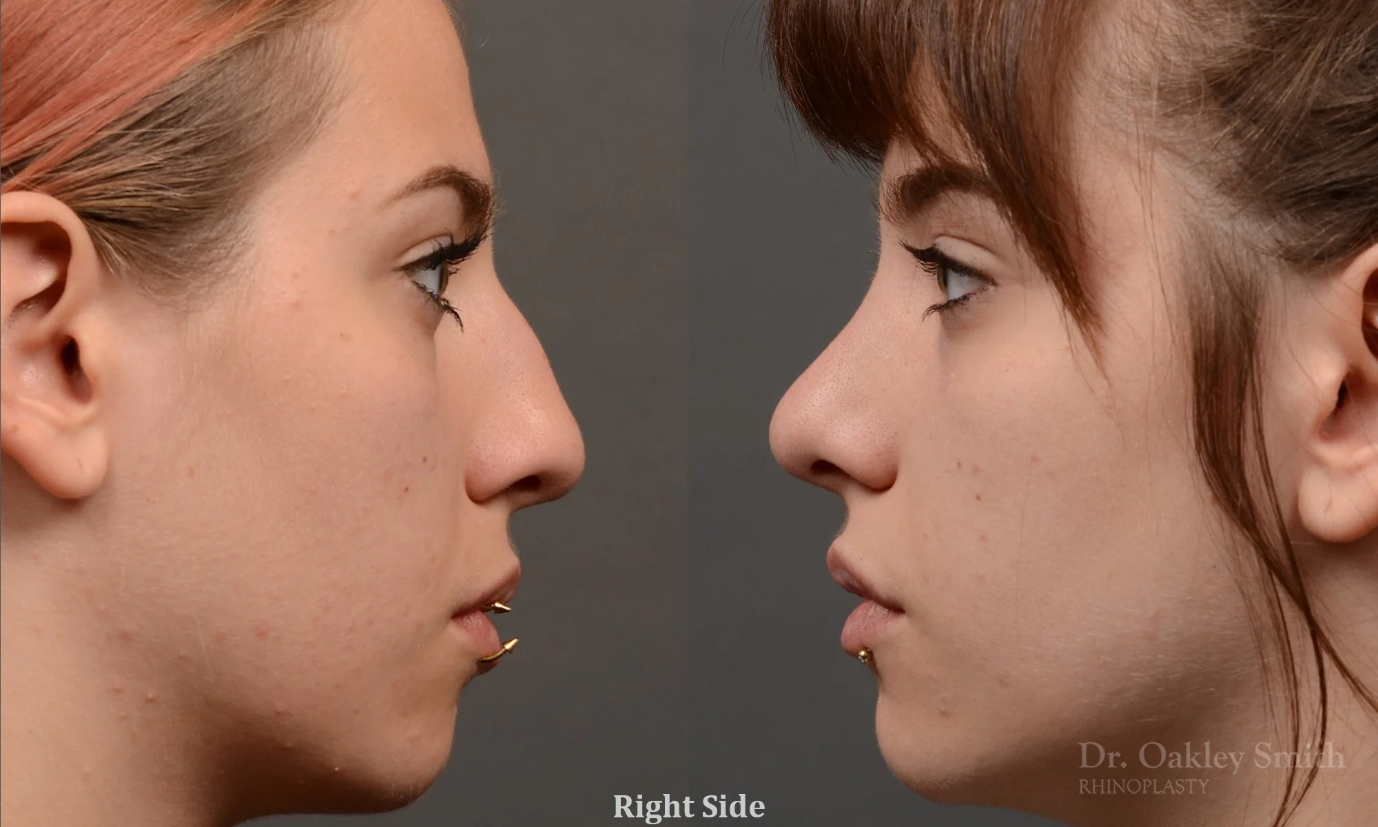 322.1C-Rhinoplasty-dr-oakley-smith-toronto-nose-job-.jpg