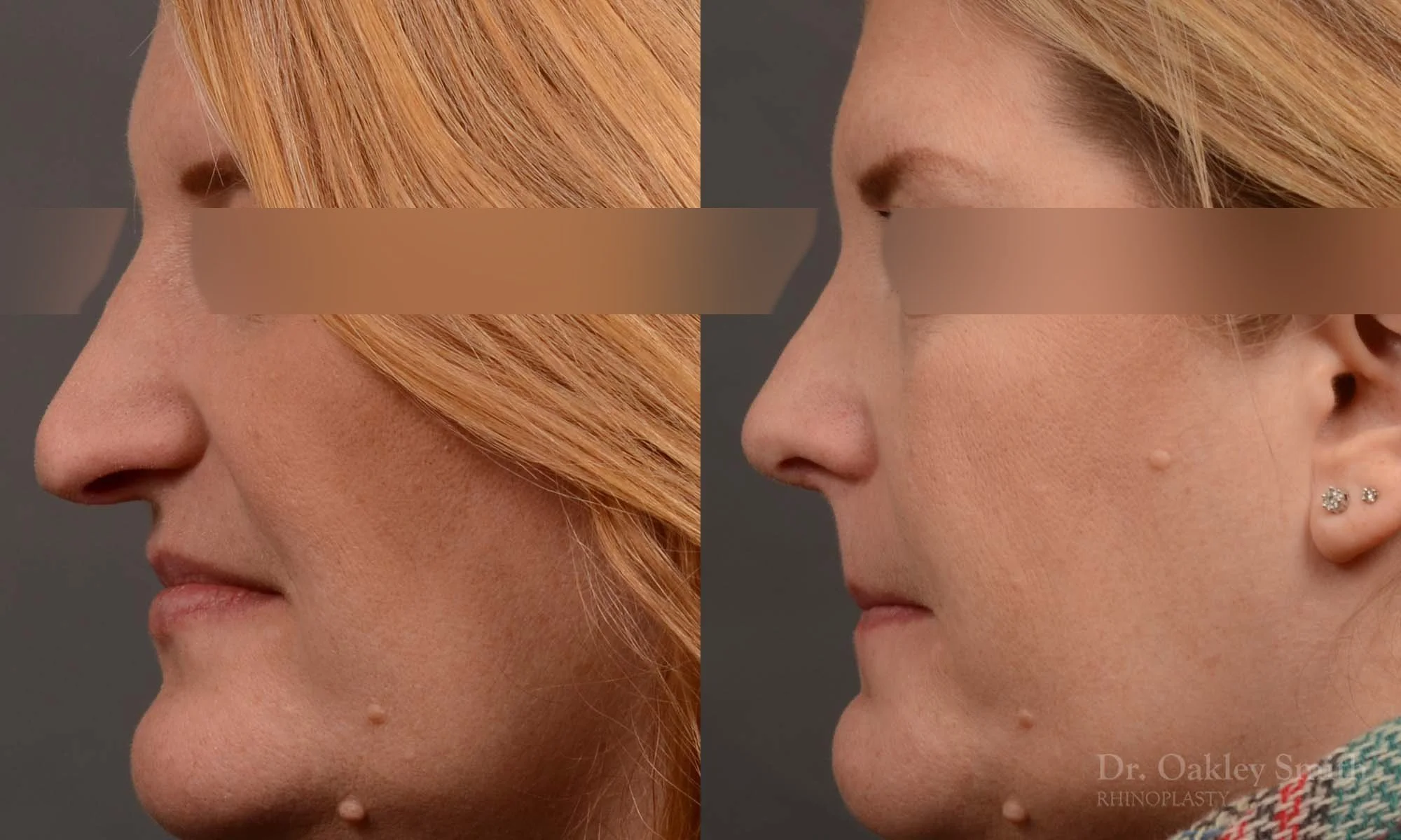 489D-rhinoplasty-dr-oakley-smith-toronto-top-surgeon-nose-job.jpg