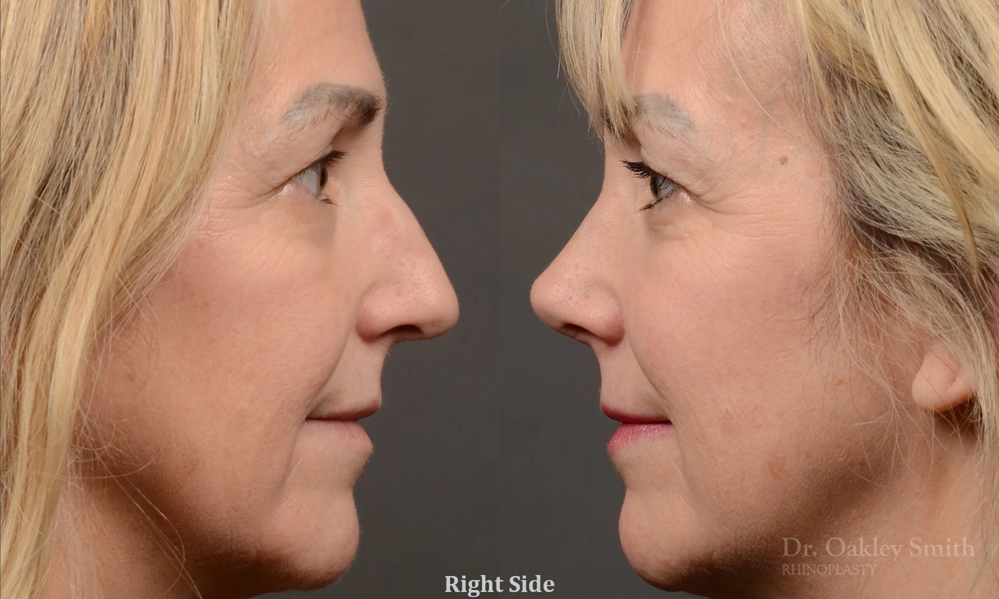 510C-rhinoplasty-dr-oakley-smith-toronto-top-surgeon-nose-job.jpg