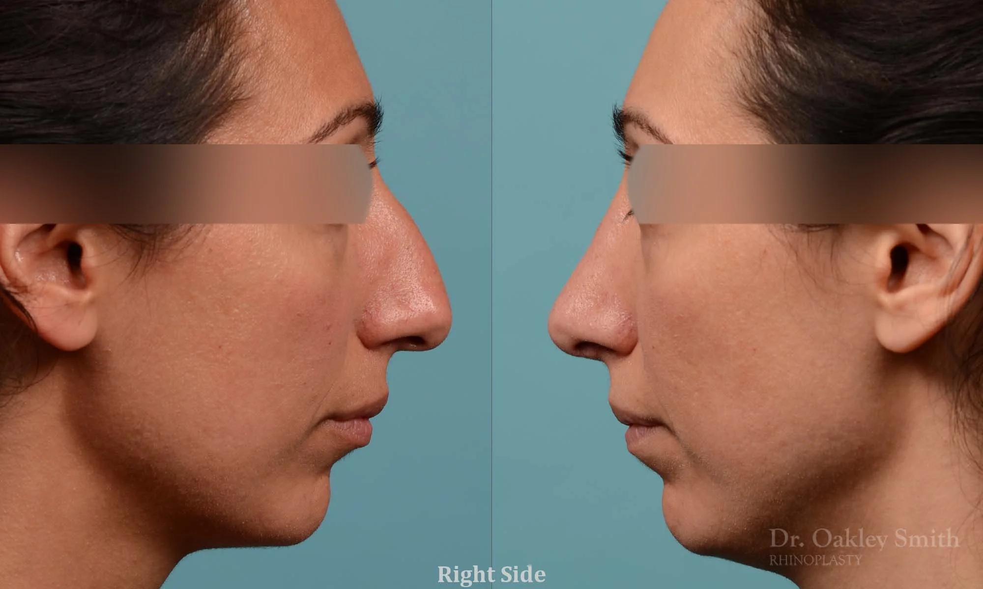 273C-rhinoplasty-dr-oakley-smith-toronto-nose-job.jpg
