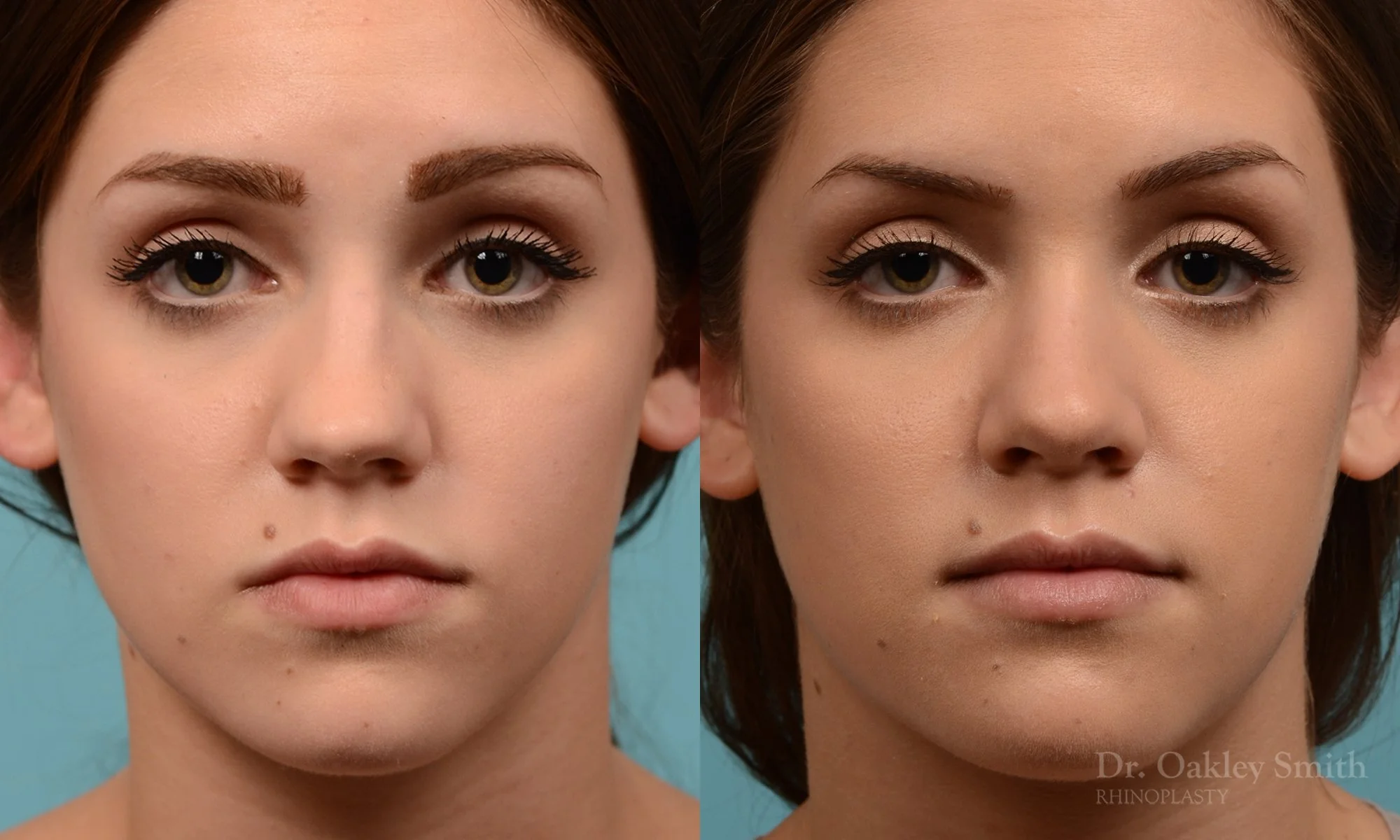 293A-rhinoplasty-dr-oakley-smith-toronto-nose-job.jpg
