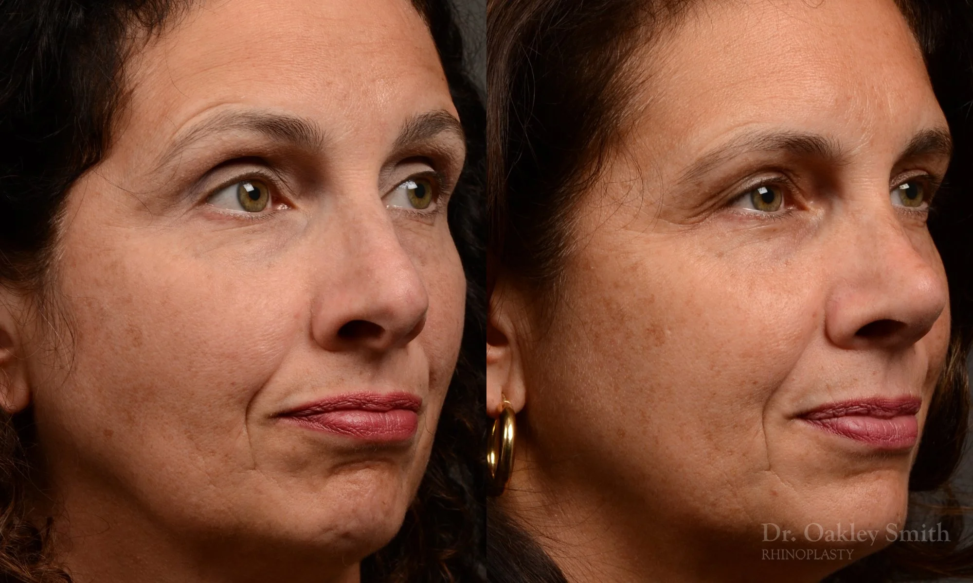 545B-rhinoplasty-nose-job-top-toronto-surgeon-dr.-oakley-smith.jpg