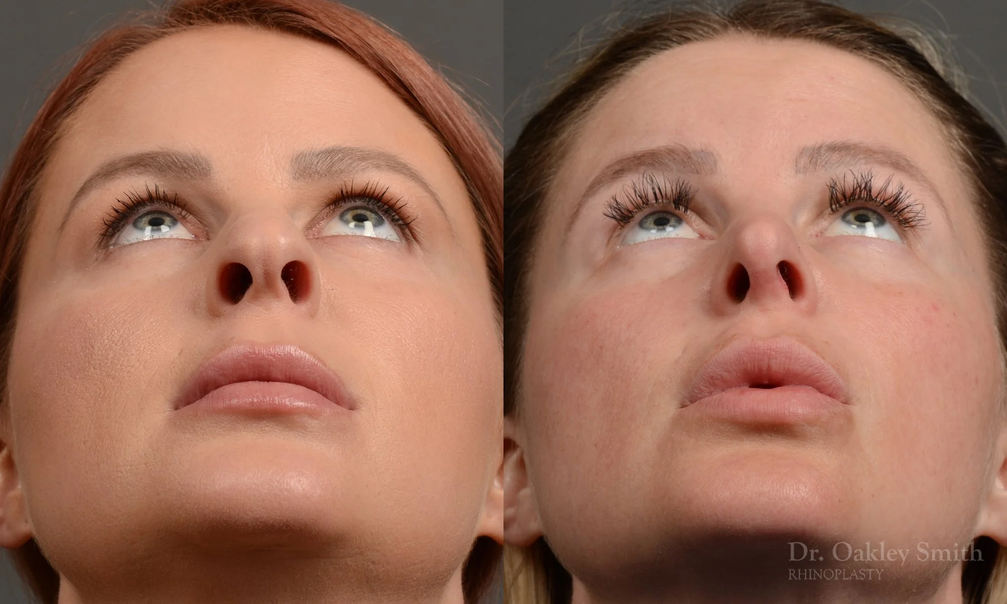 361F-rhinoplasty-dr-oakley-smith-toronto-nose-job.jpg