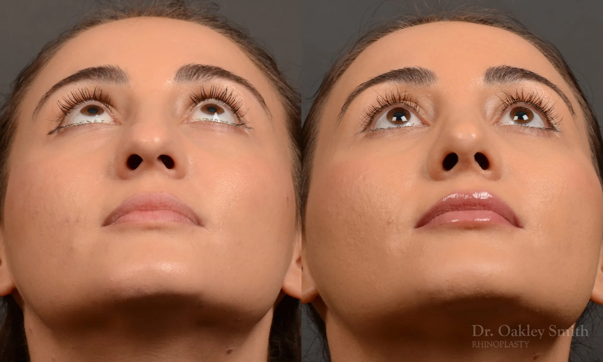 522F-rhinoplasty-dr-oakley-smith-toronto-top-surgeon-nose-job.jpg