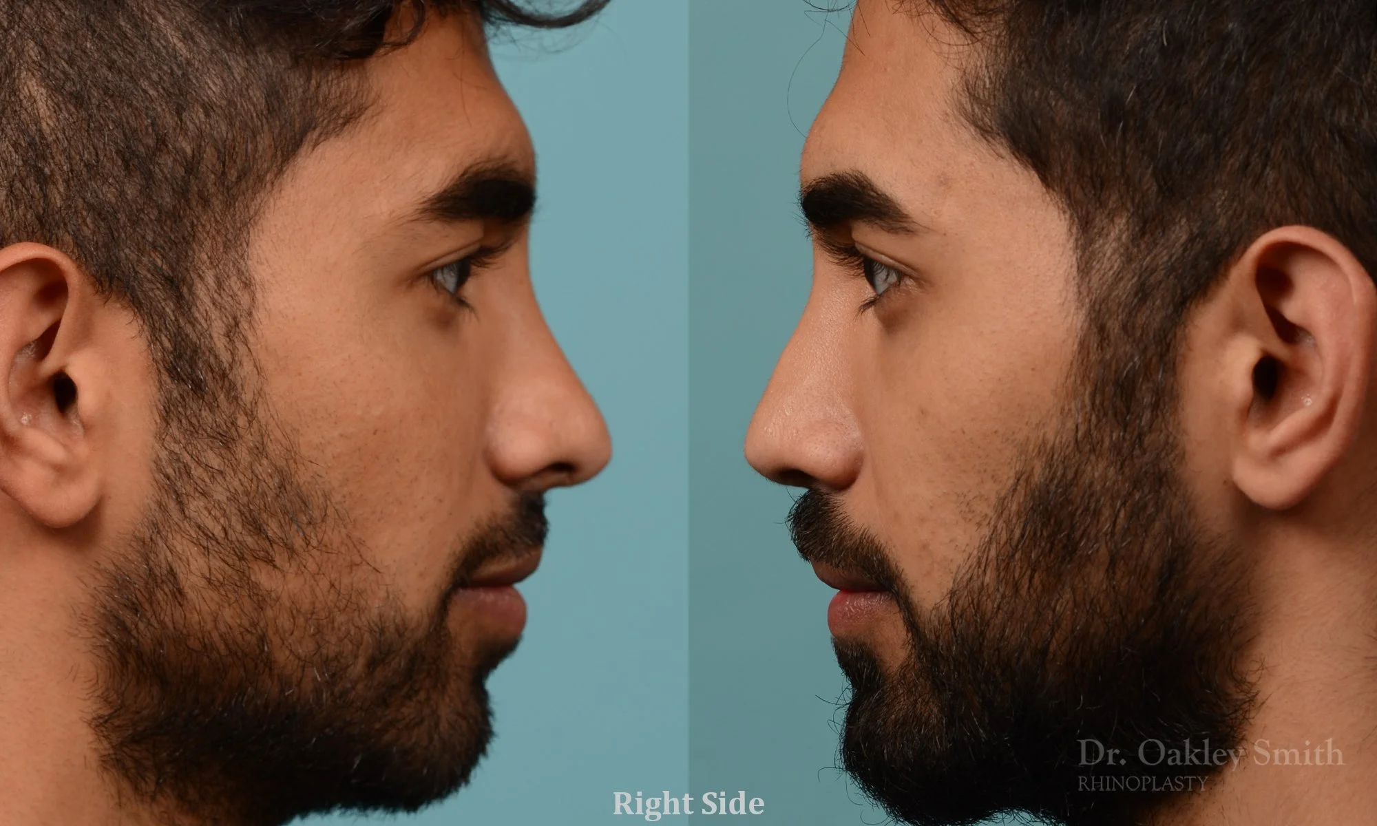 201: Primary Male Rhinoplasty, Normal Skin, Bridge Augmentation, Tip, Ethnic Rhinoplasty