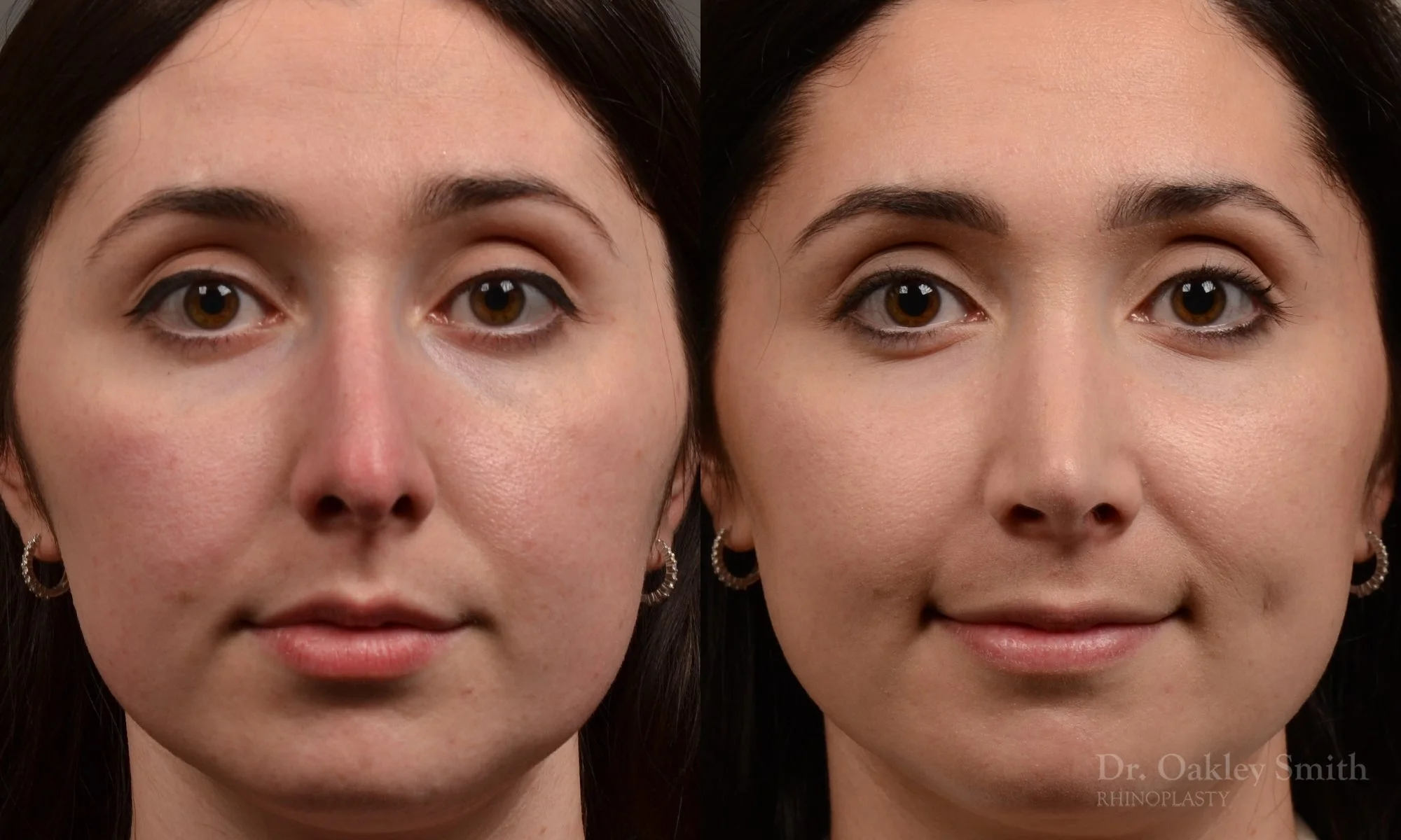 476A-rhinoplasty-dr-oakley-smith-toronto-top-surgeon-nose-job.jpg