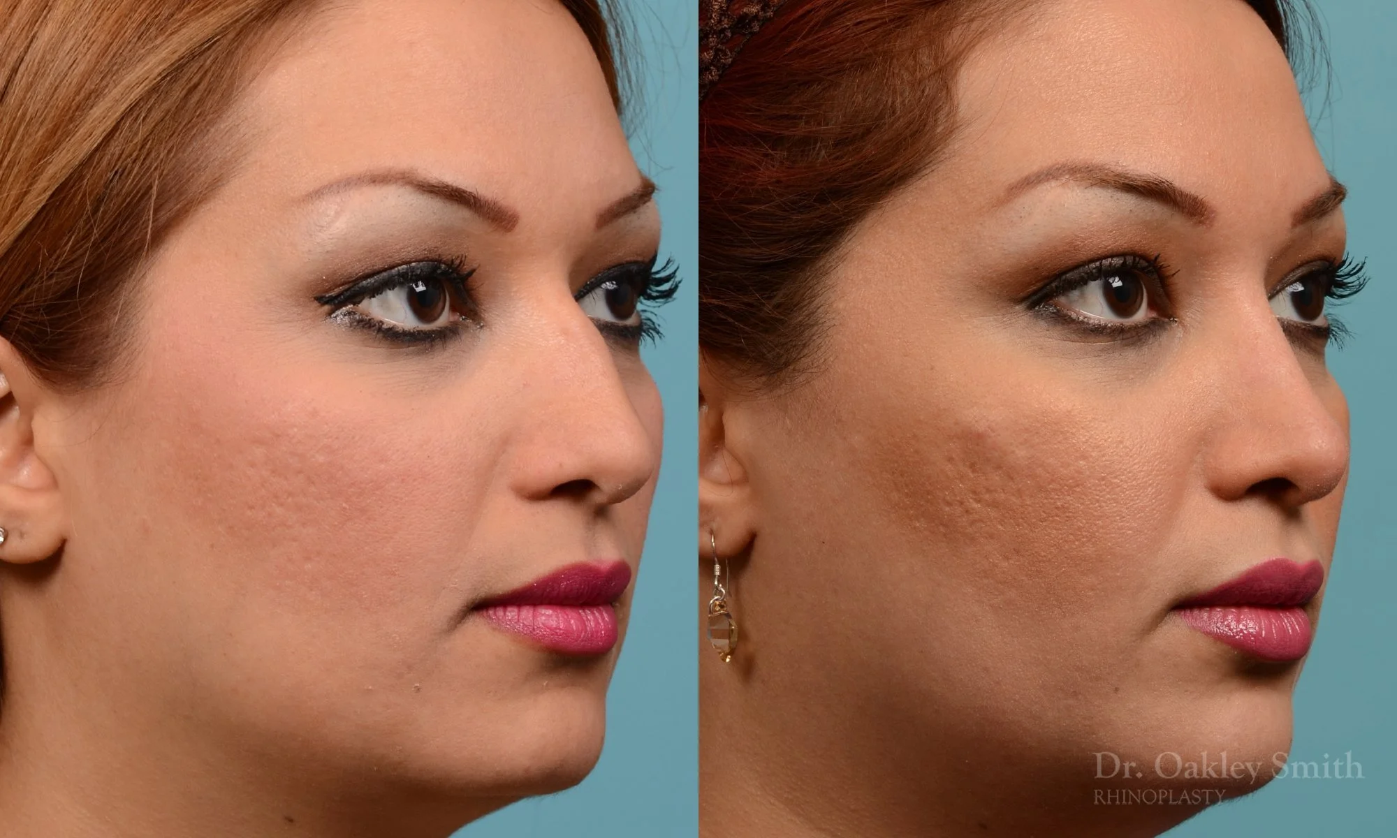 260B-rhinoplasty-dr-oakley-smith-toronto-nose-job.jpg