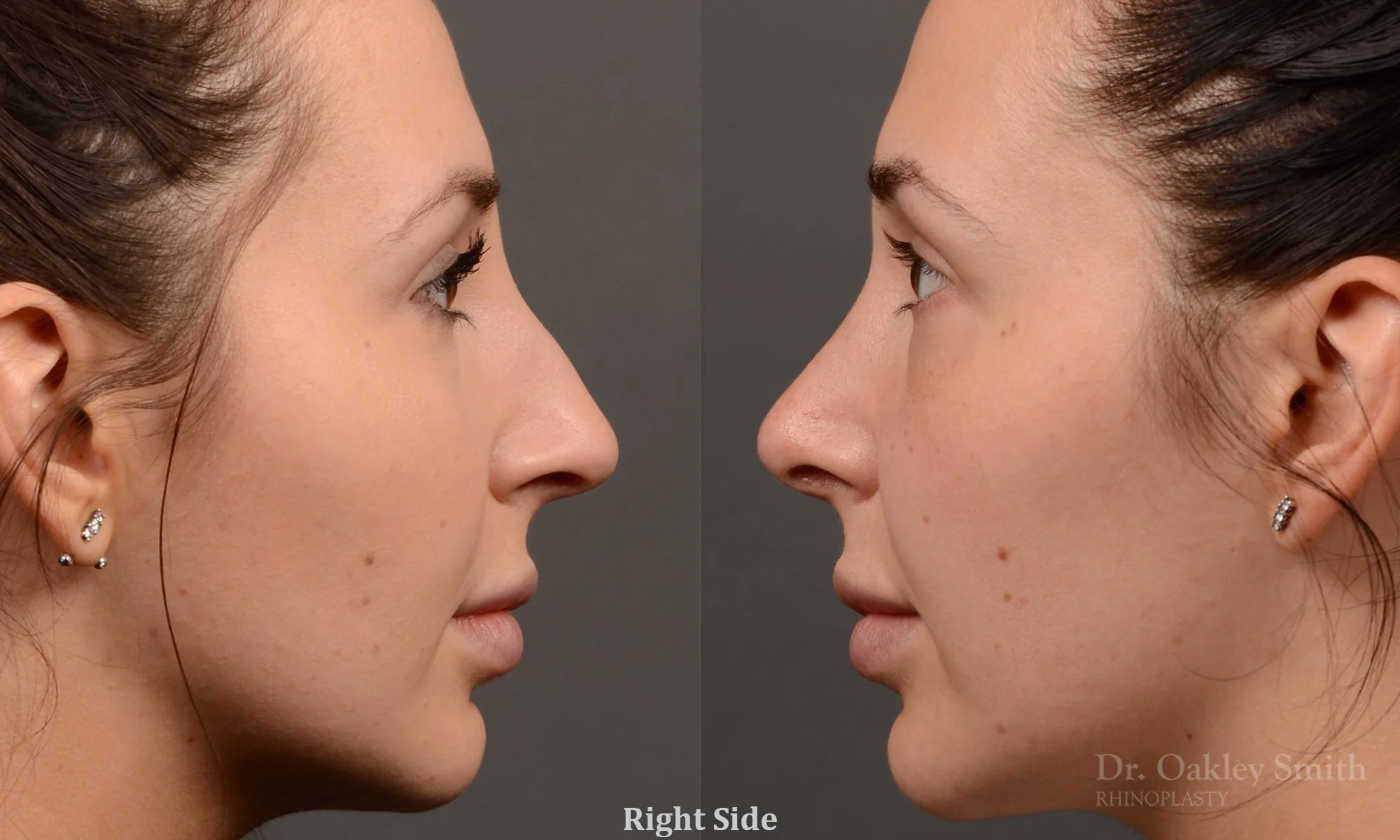 294C-rhinoplasty-dr-oakley-smith-toronto-nose-job.jpg