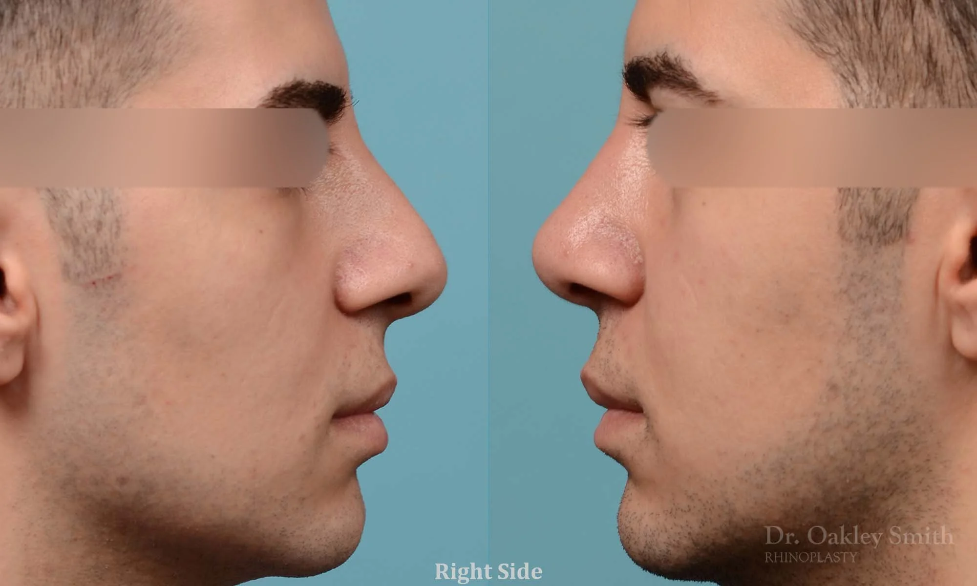 251: Primary Male Rhinoplasty, Normal Skin,  Dorsal Straightening, Tip Refinement