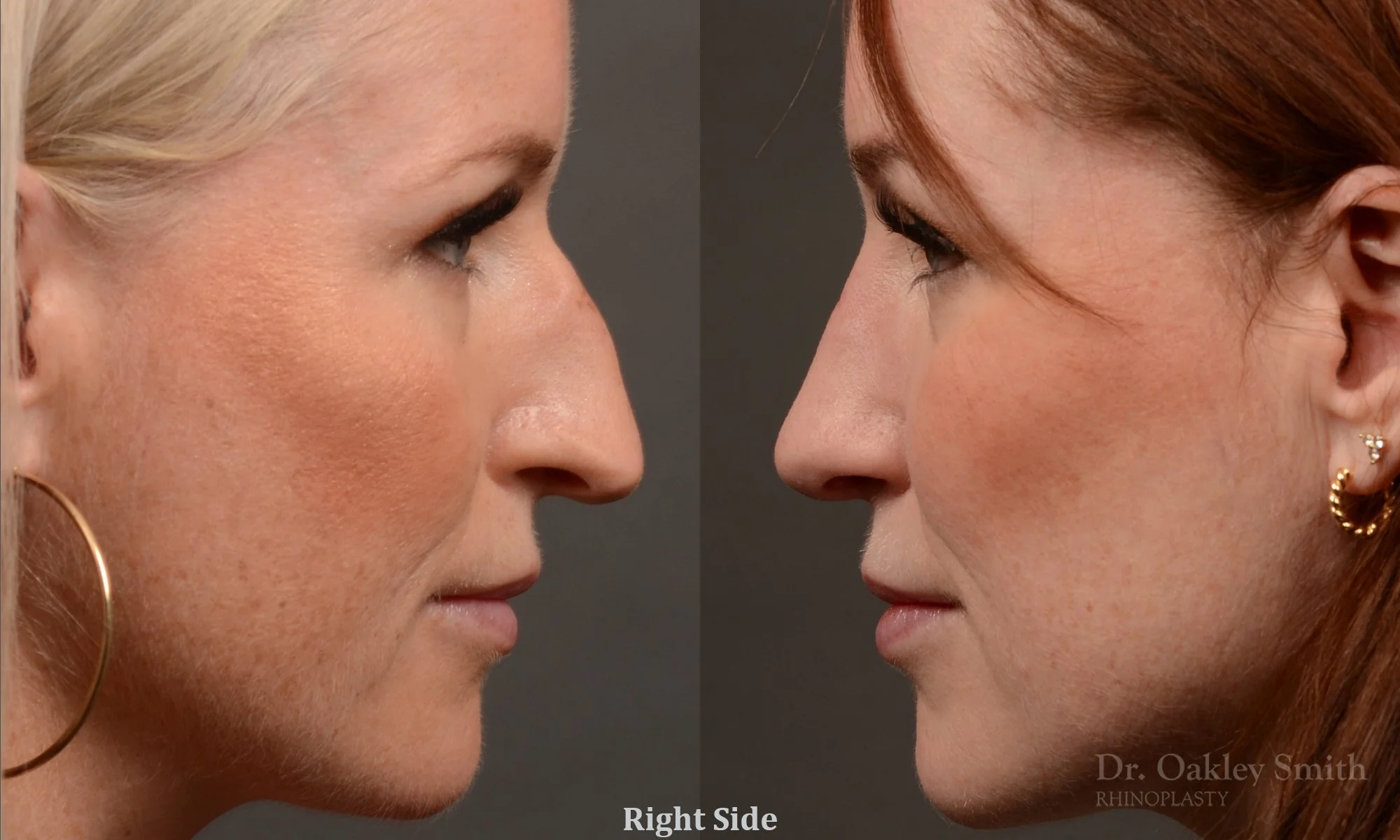 528: Female, Primary Rhinoplasty, Thin Skin, Bridge Work, Tip Work, Crooked